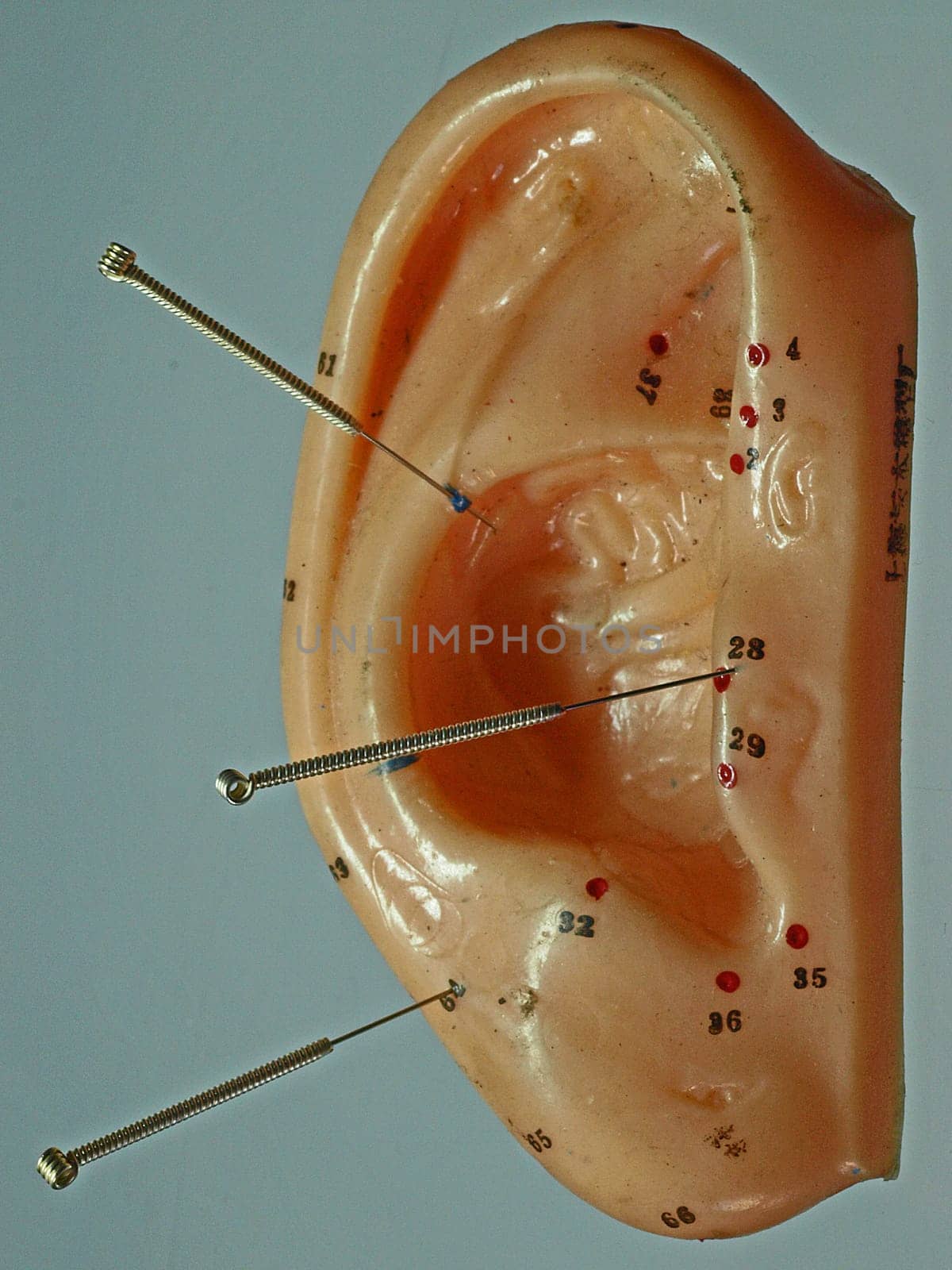 Ear Acupuncture