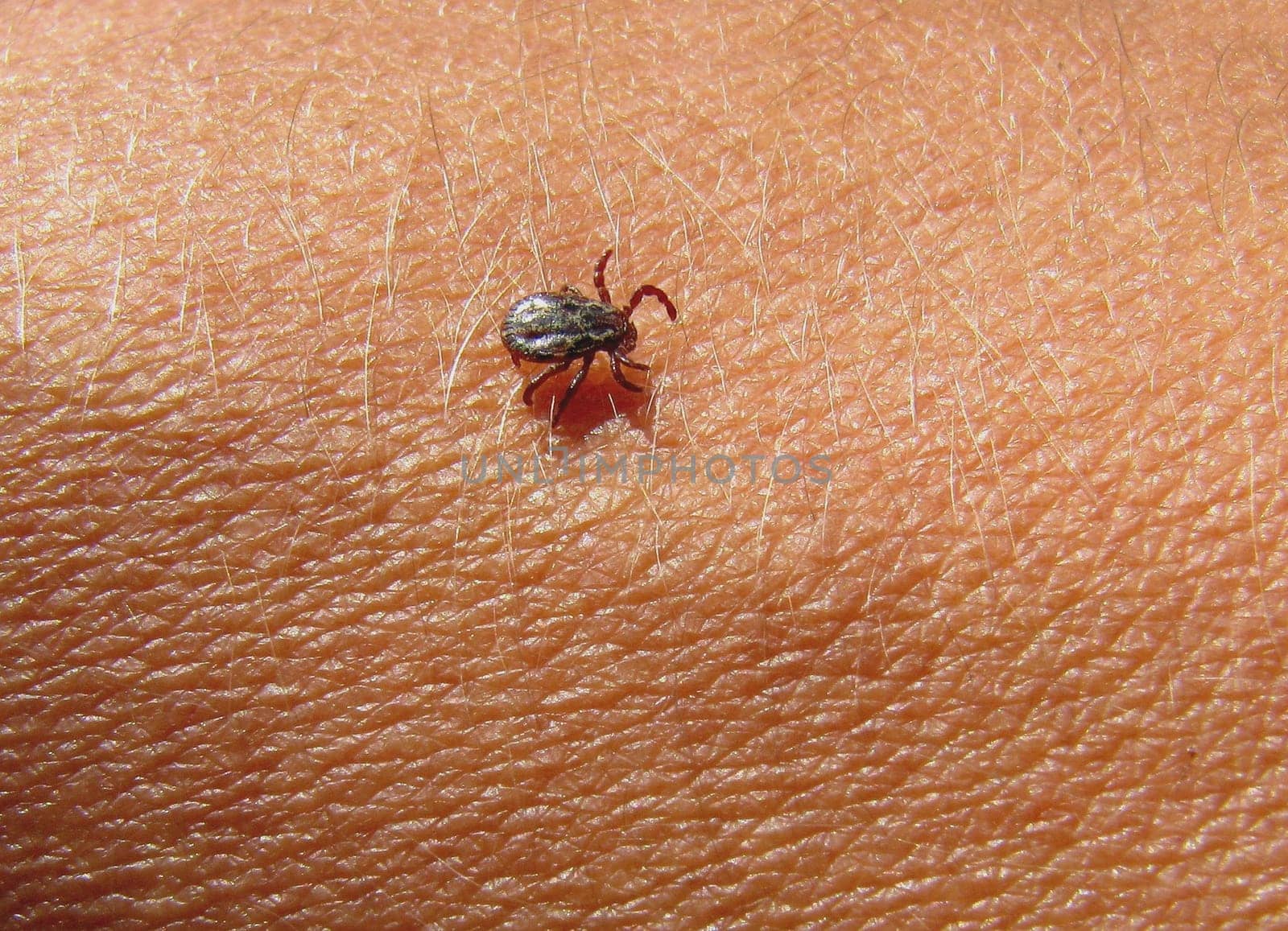 Tick on the skin