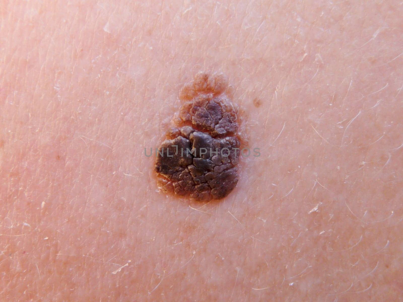 Age wart