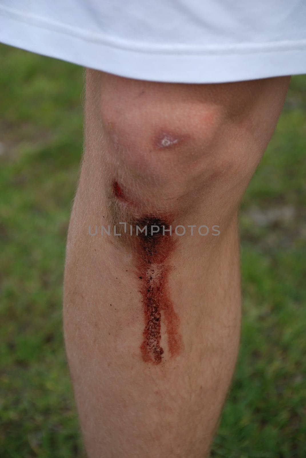 Sports accident wound knee