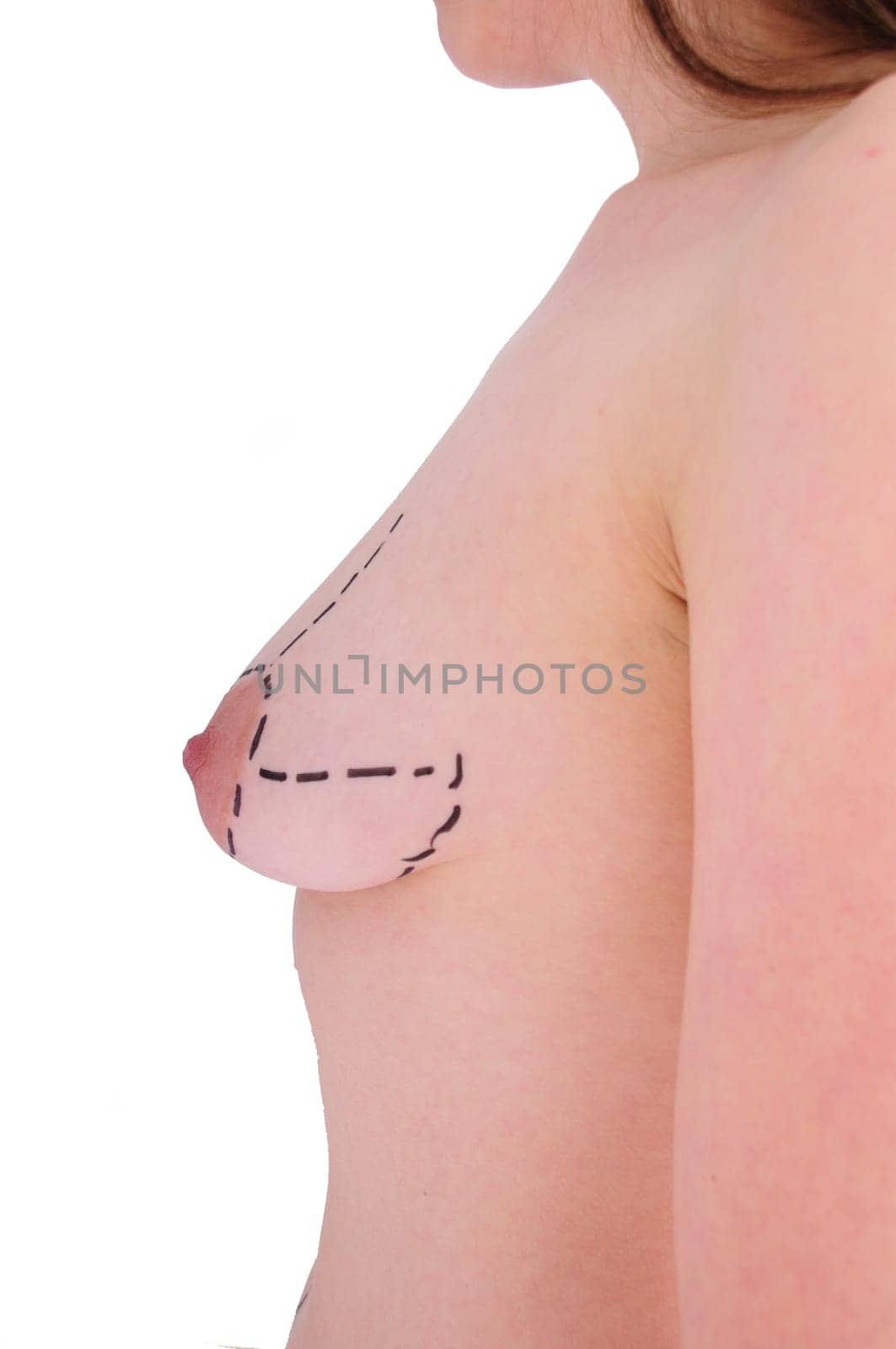 female breast before plastic surgery