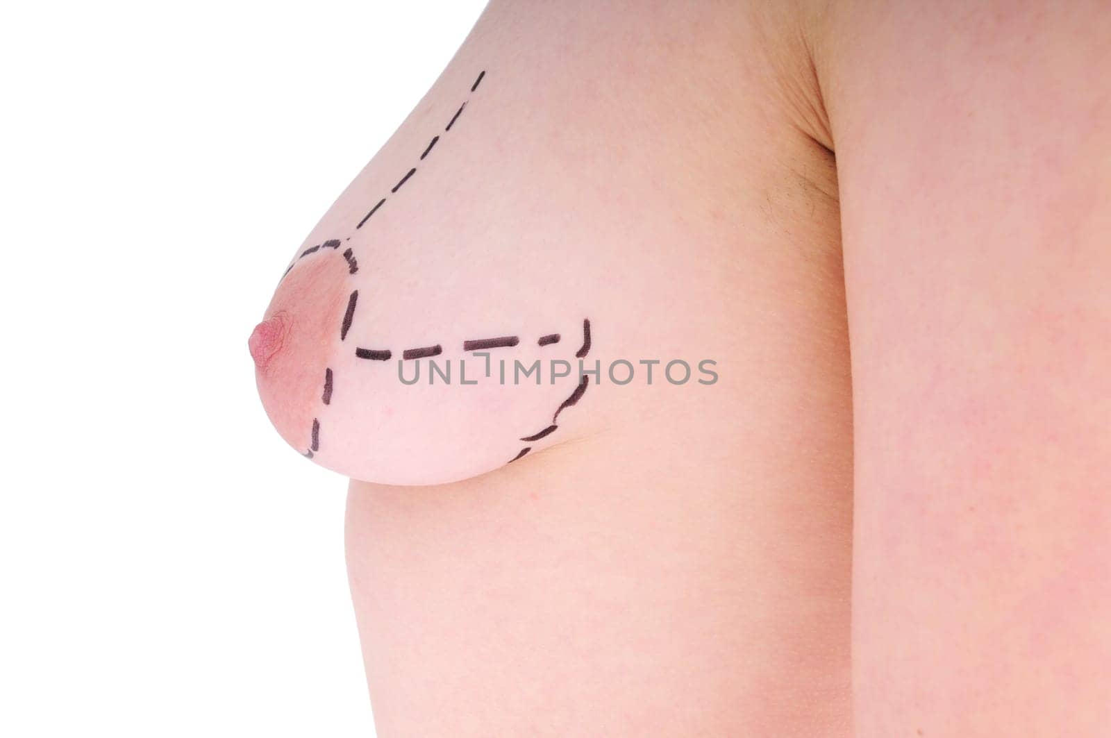 female breast before plastic surgery