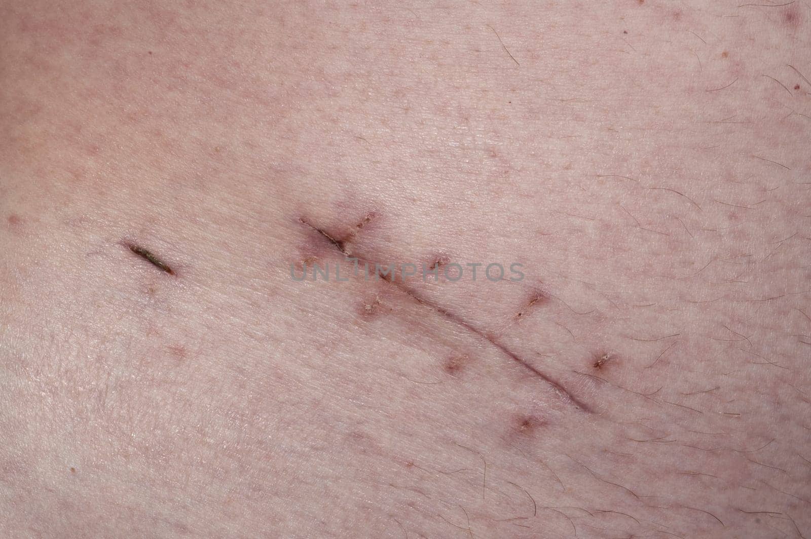 Scar - Surgery