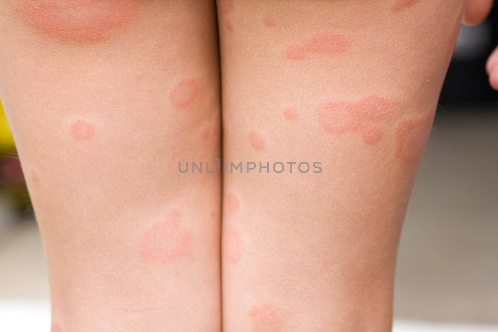 Rubella