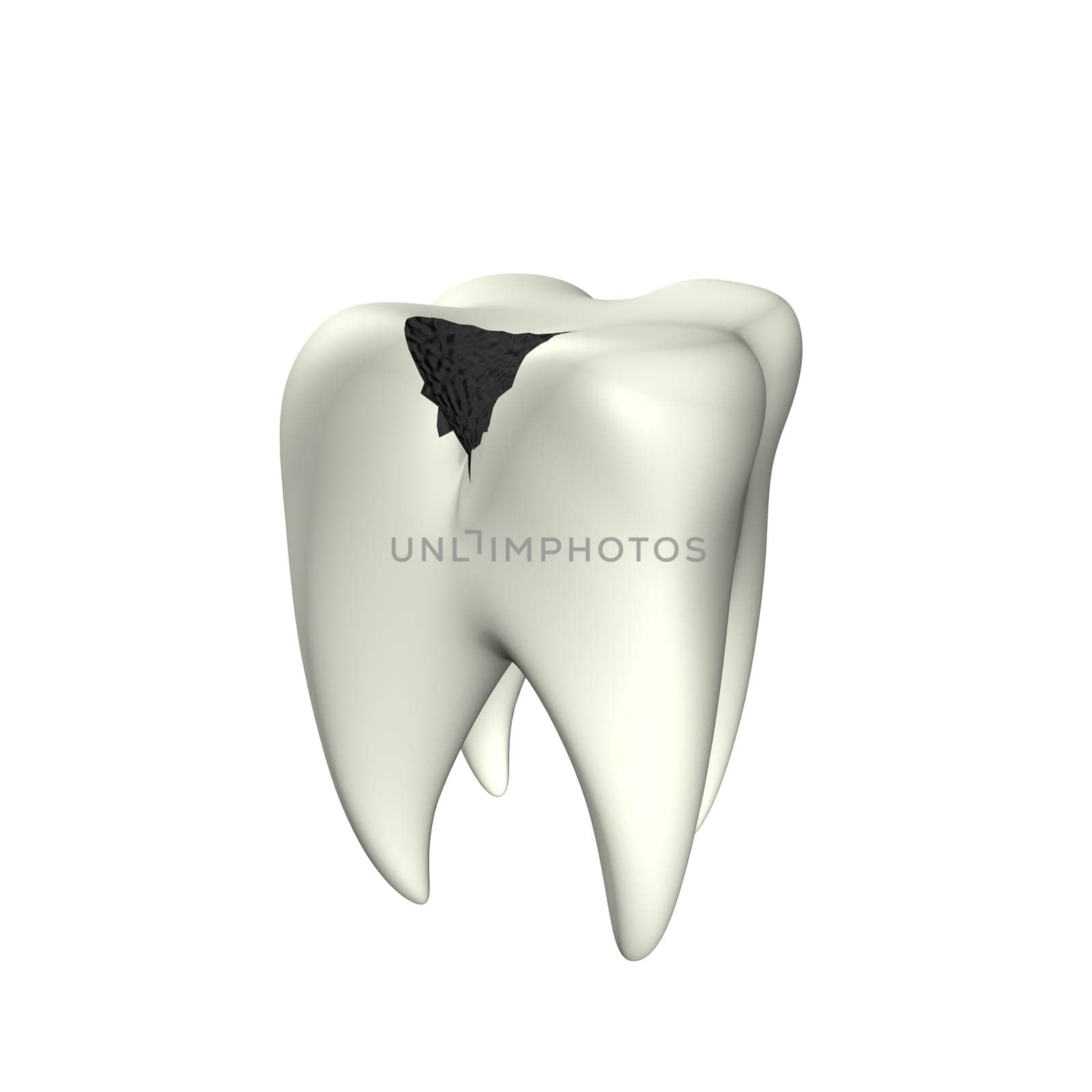 Dental Caries 3D