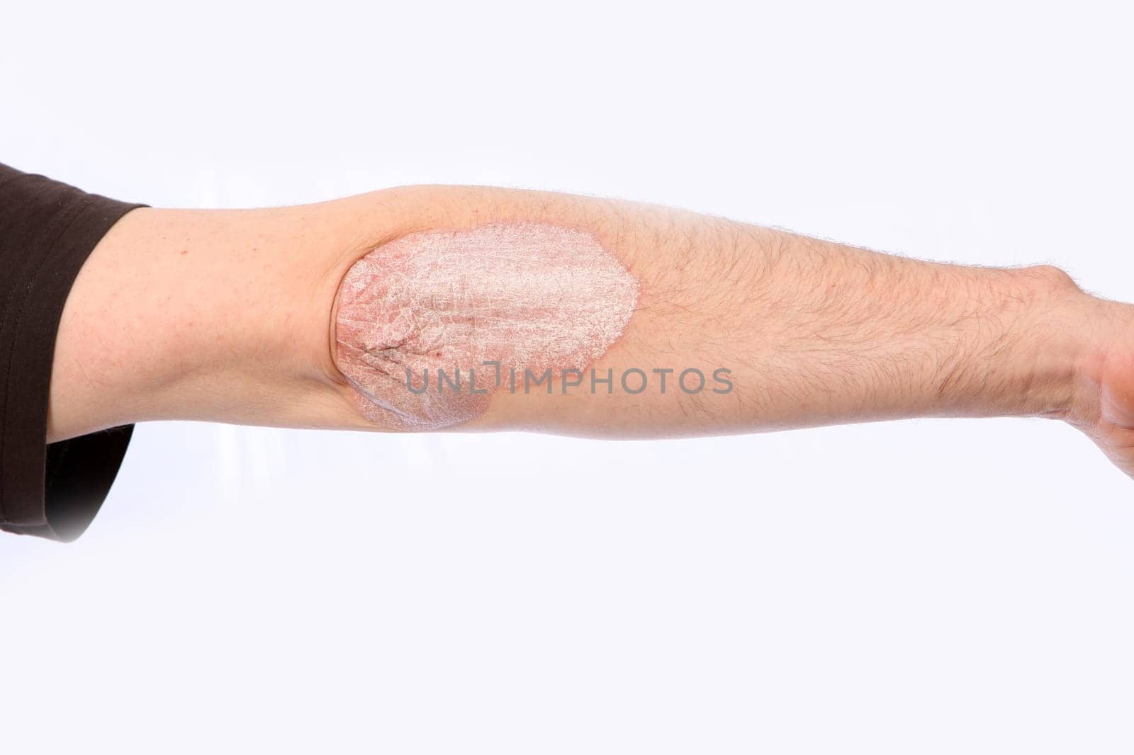 Psoriasis on the leg