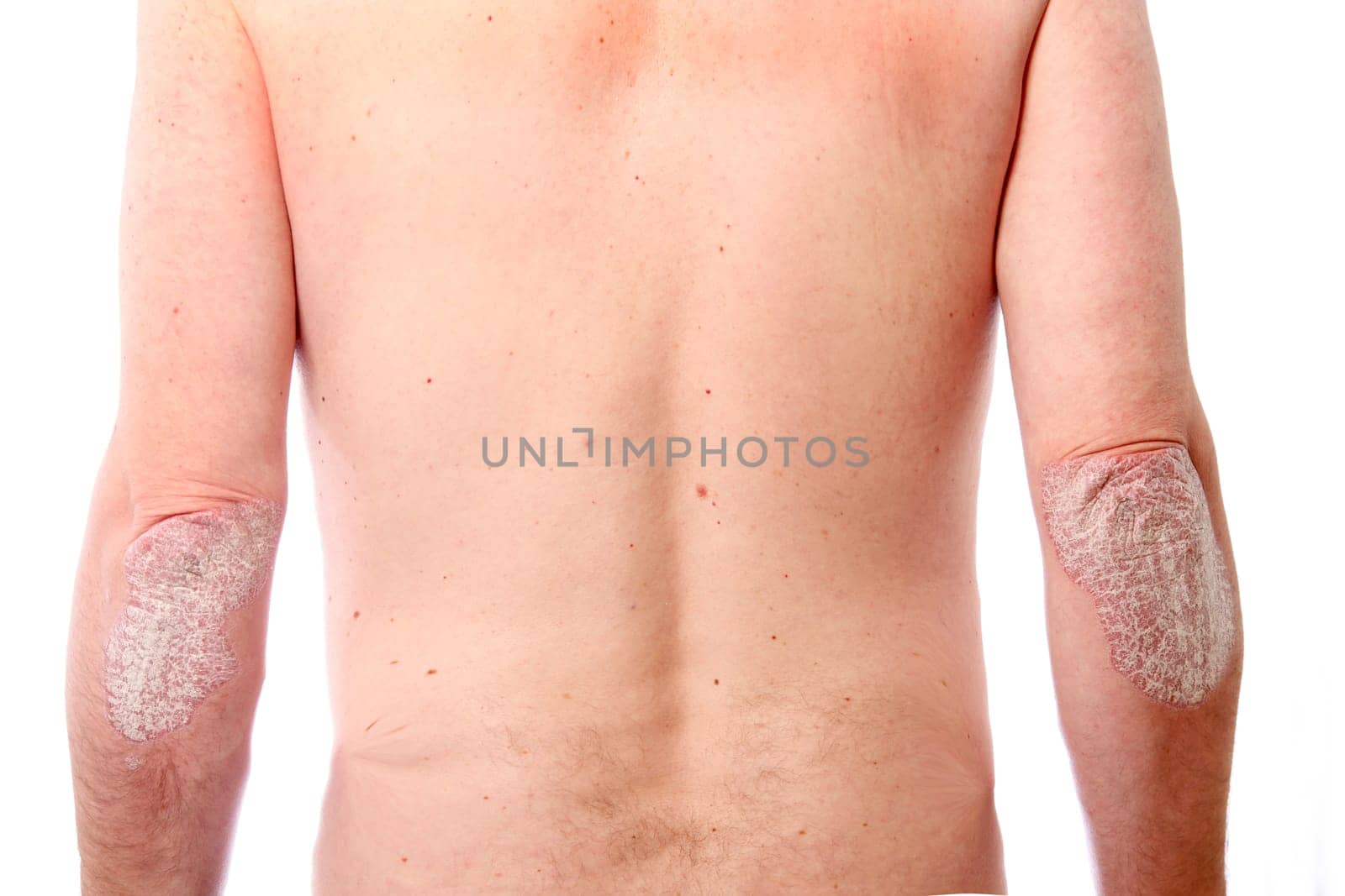 pronounced Psoriasis on both elbows
