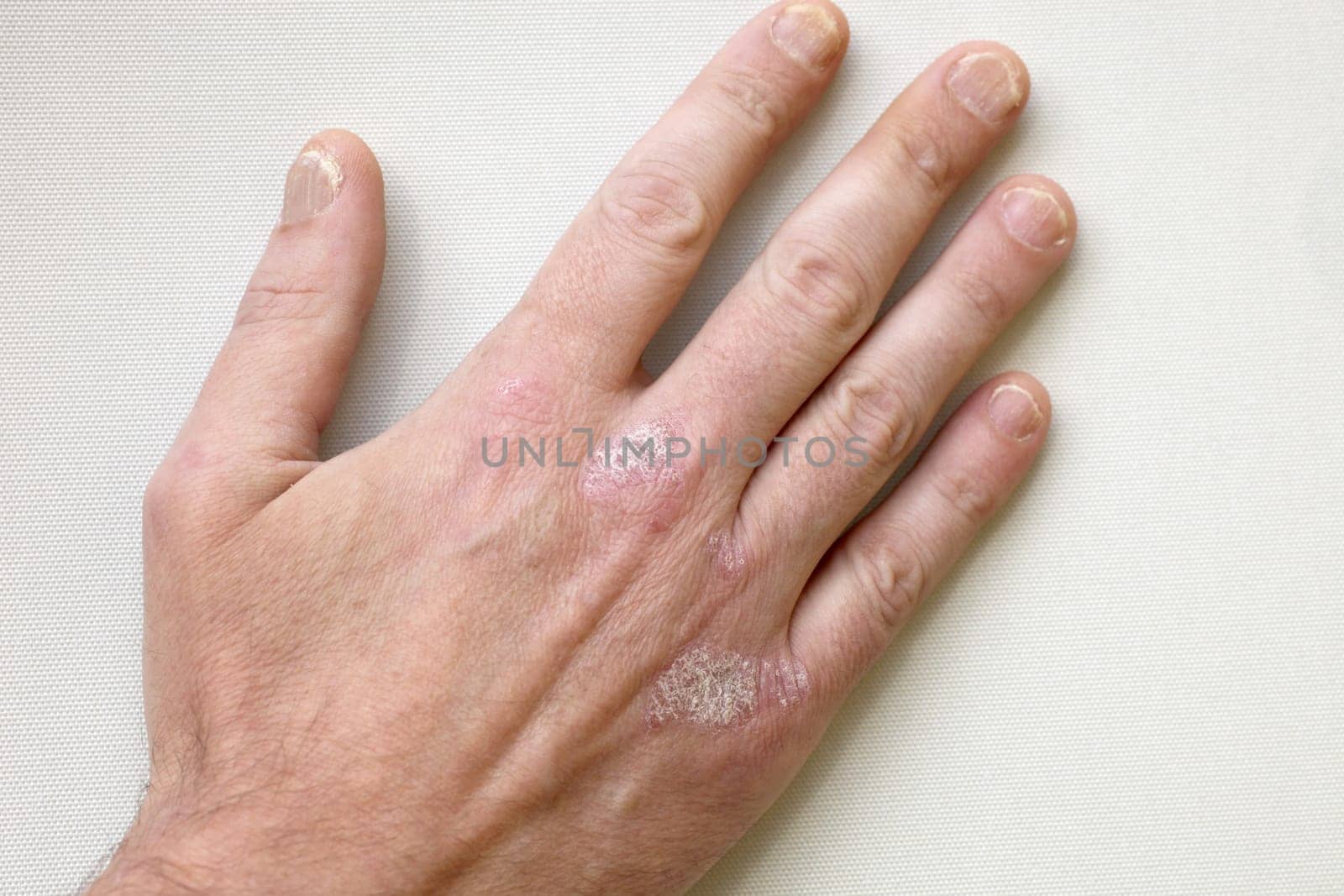 Psoriasis - Psoriasis on the hands and fingernails