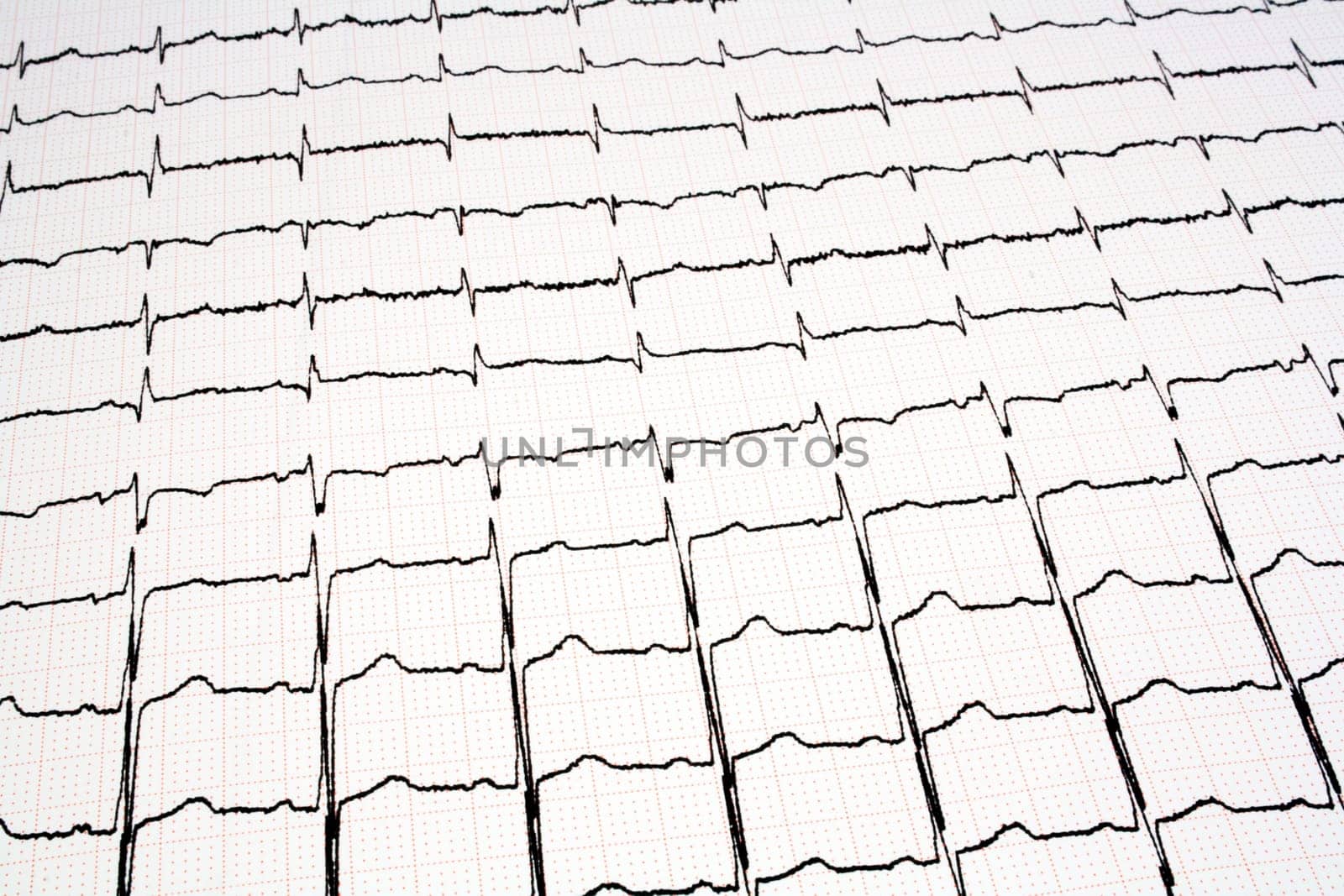 ECG - EKG graph