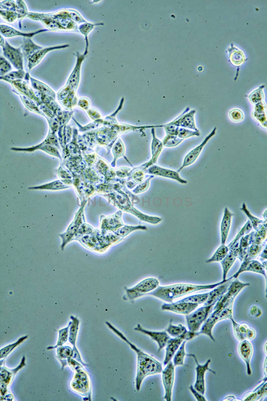 Microscope view of mens health Prostate Cancer cells in tissue culture showing walls, nucleus and organelles.