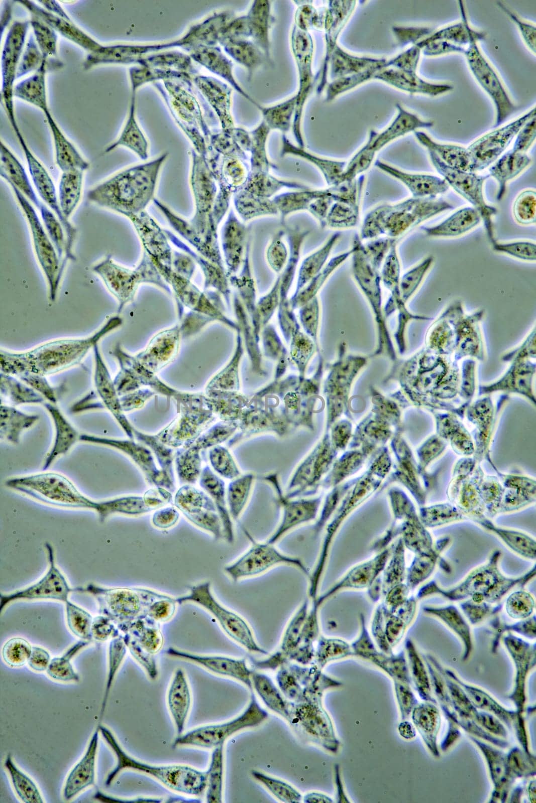 Microscope view of mens health Prostate Cancer cells in tissue culture showing walls, nucleus and organelles.