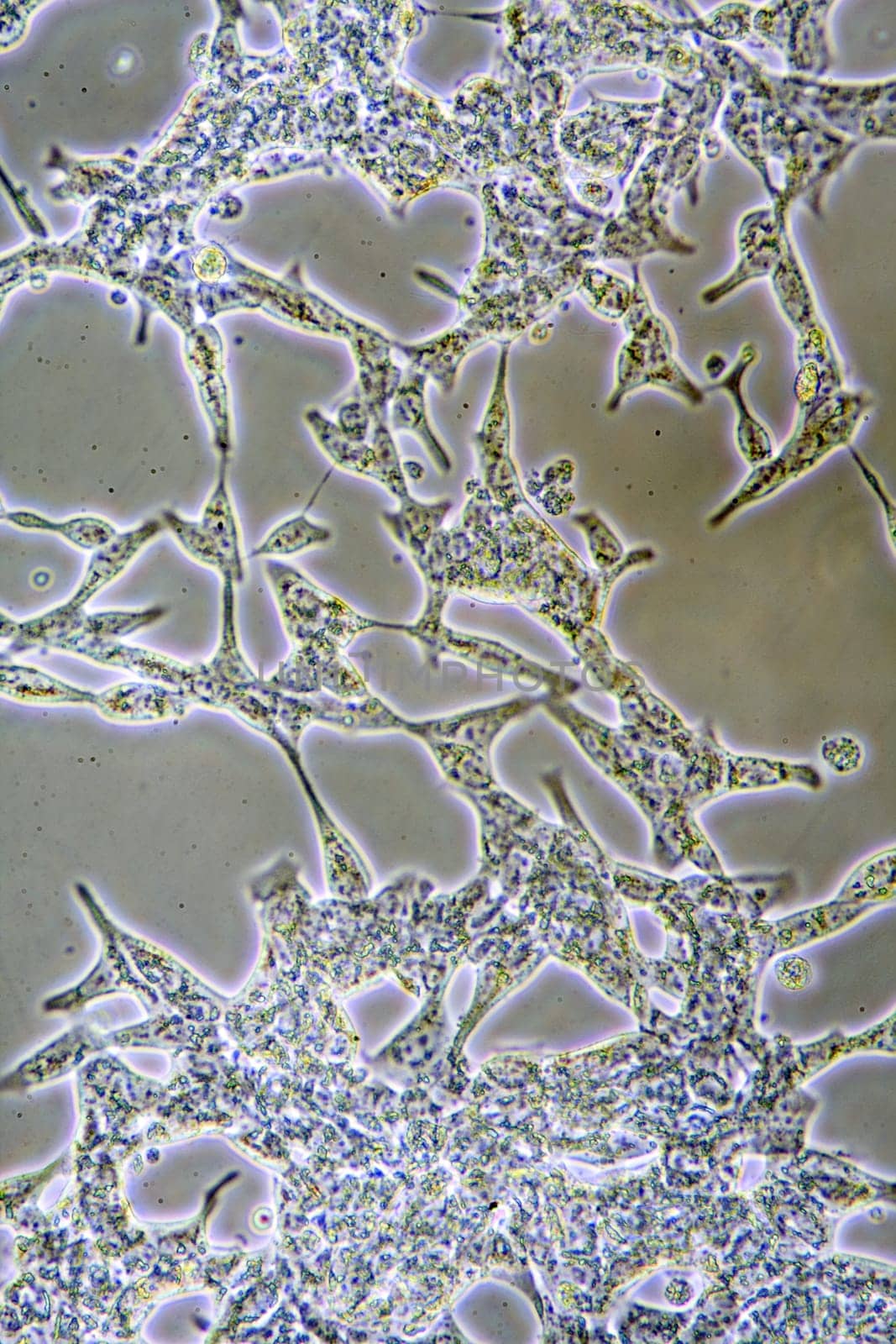 Microscope view of mens health Prostate Cancer cells in tissue culture showing walls, nucleus and organelles.