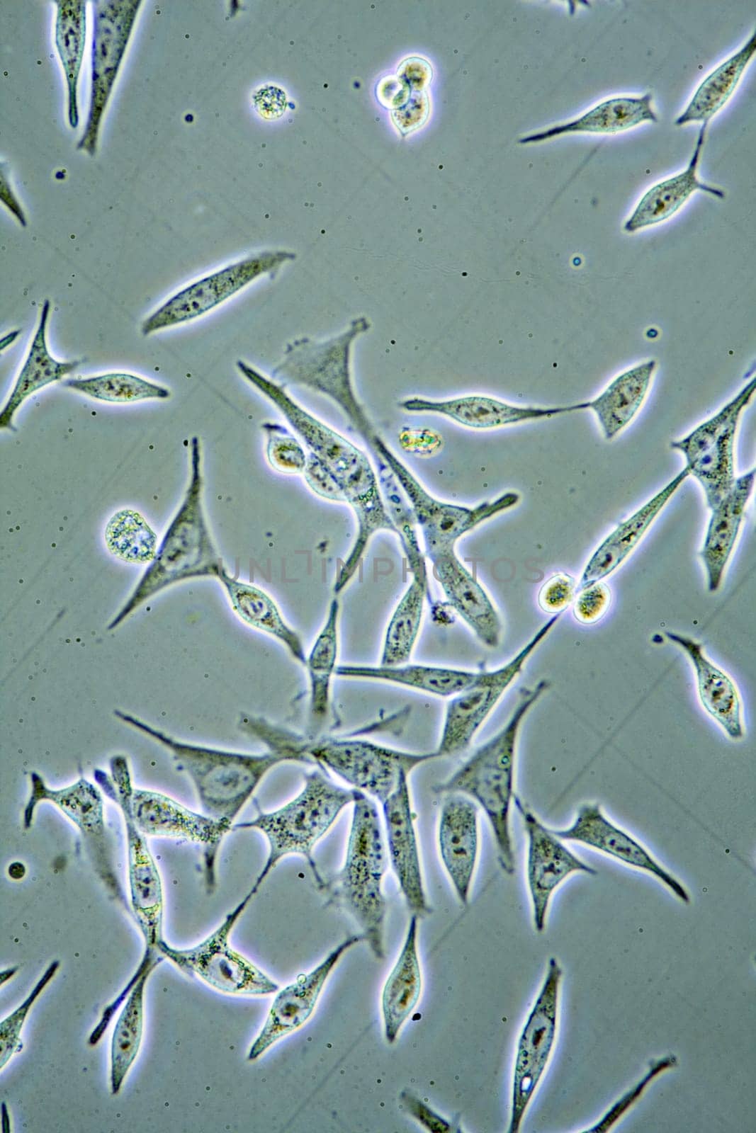Microscope view of mens health Prostate Cancer cells in tissue culture showing walls, nucleus and organelles.