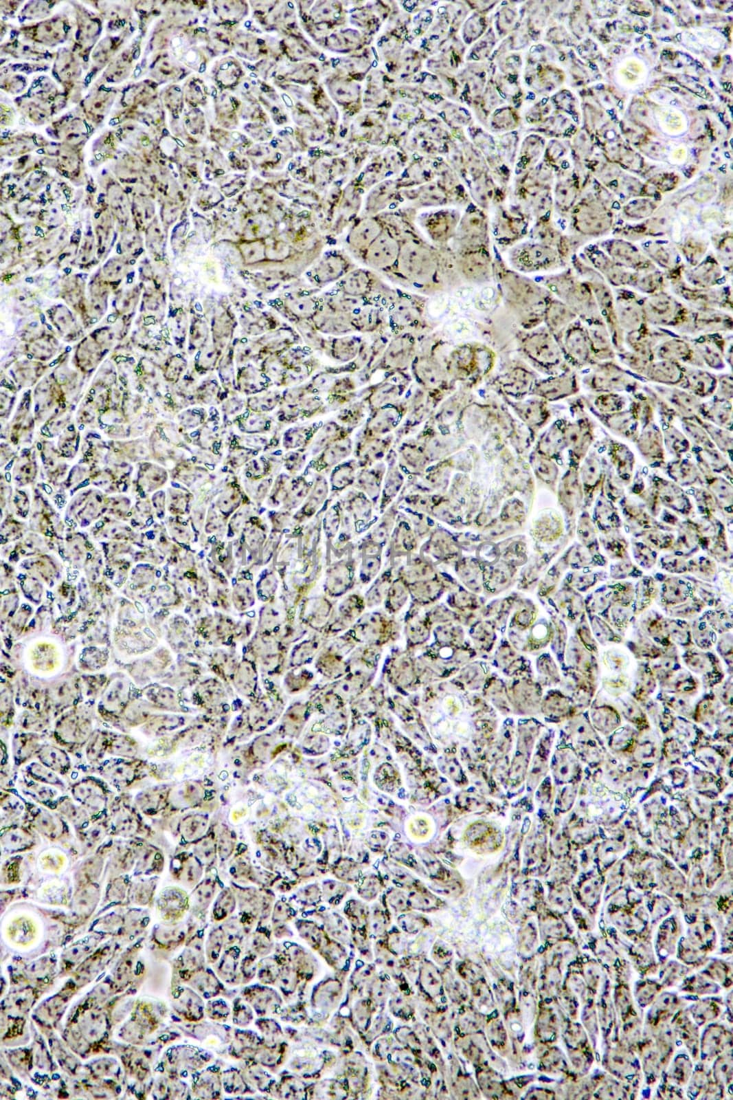 Microscope view of Colon Cancer cells in tissue culture showing walls, nucleus and organelles.