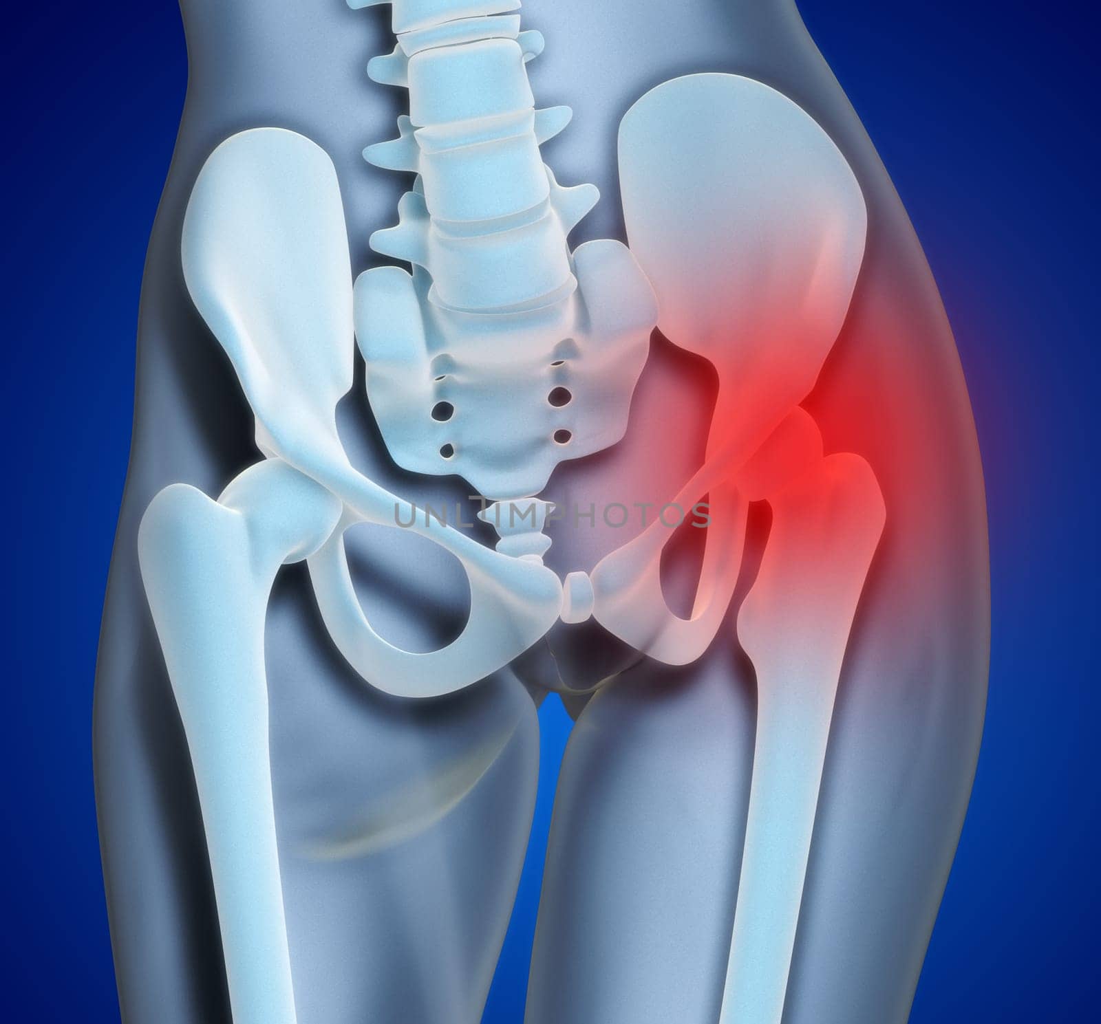 An illustration of a foot xray with a red spot showing the injured ankle.