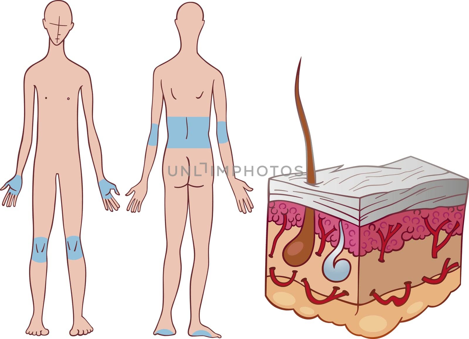 Illustration of psoriasis skin disease