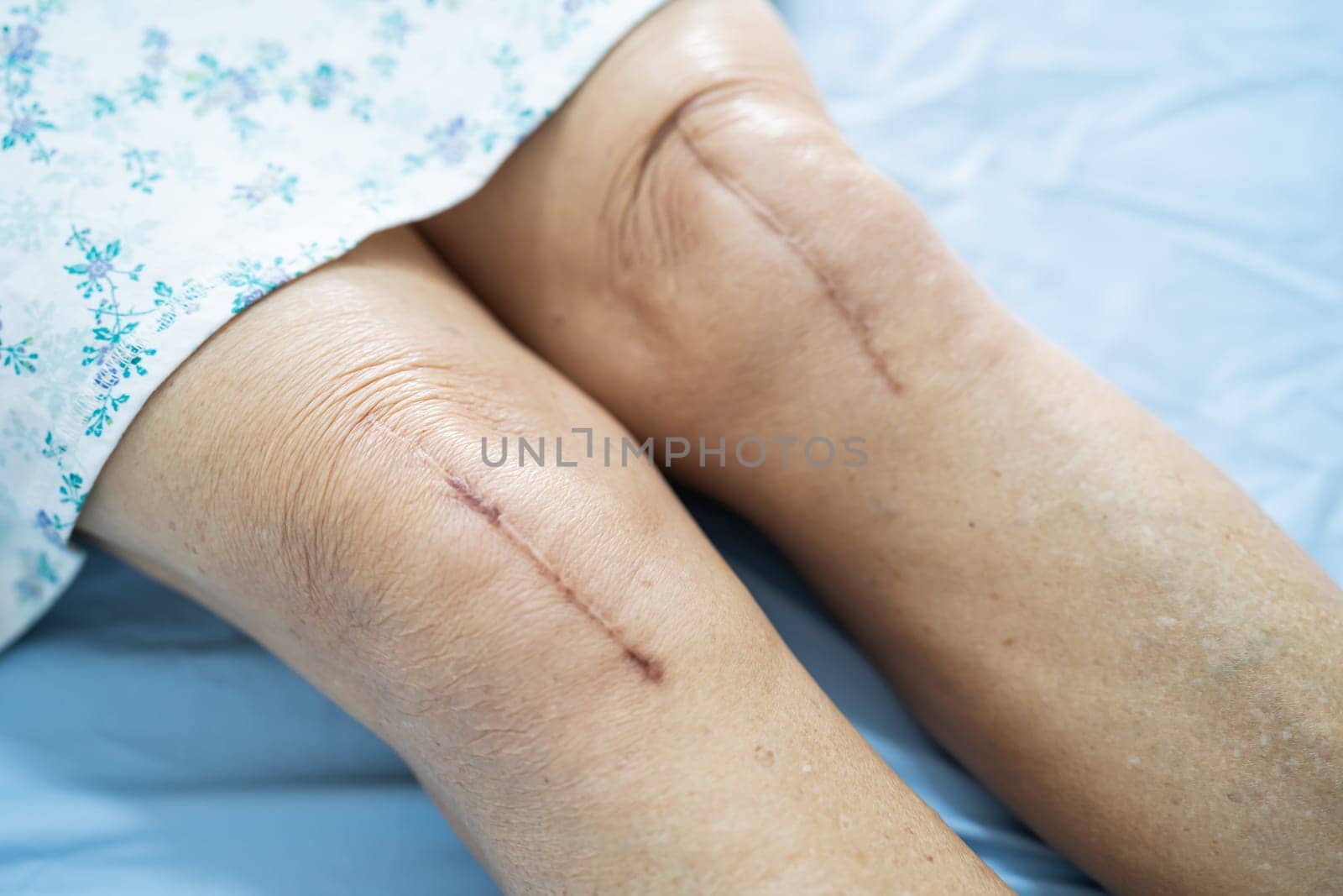 Asian elderly woman patient show her scars surgical total knee joint replacement Suture wound surgery arthroplasty on bed in nursing hospital ward, healthy strong medical concept. by pamai