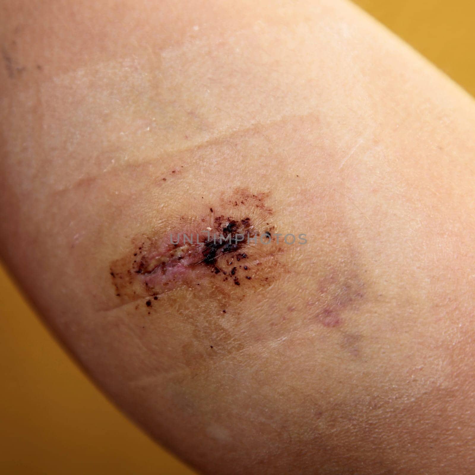 Close-up - injury with stitched wound - square