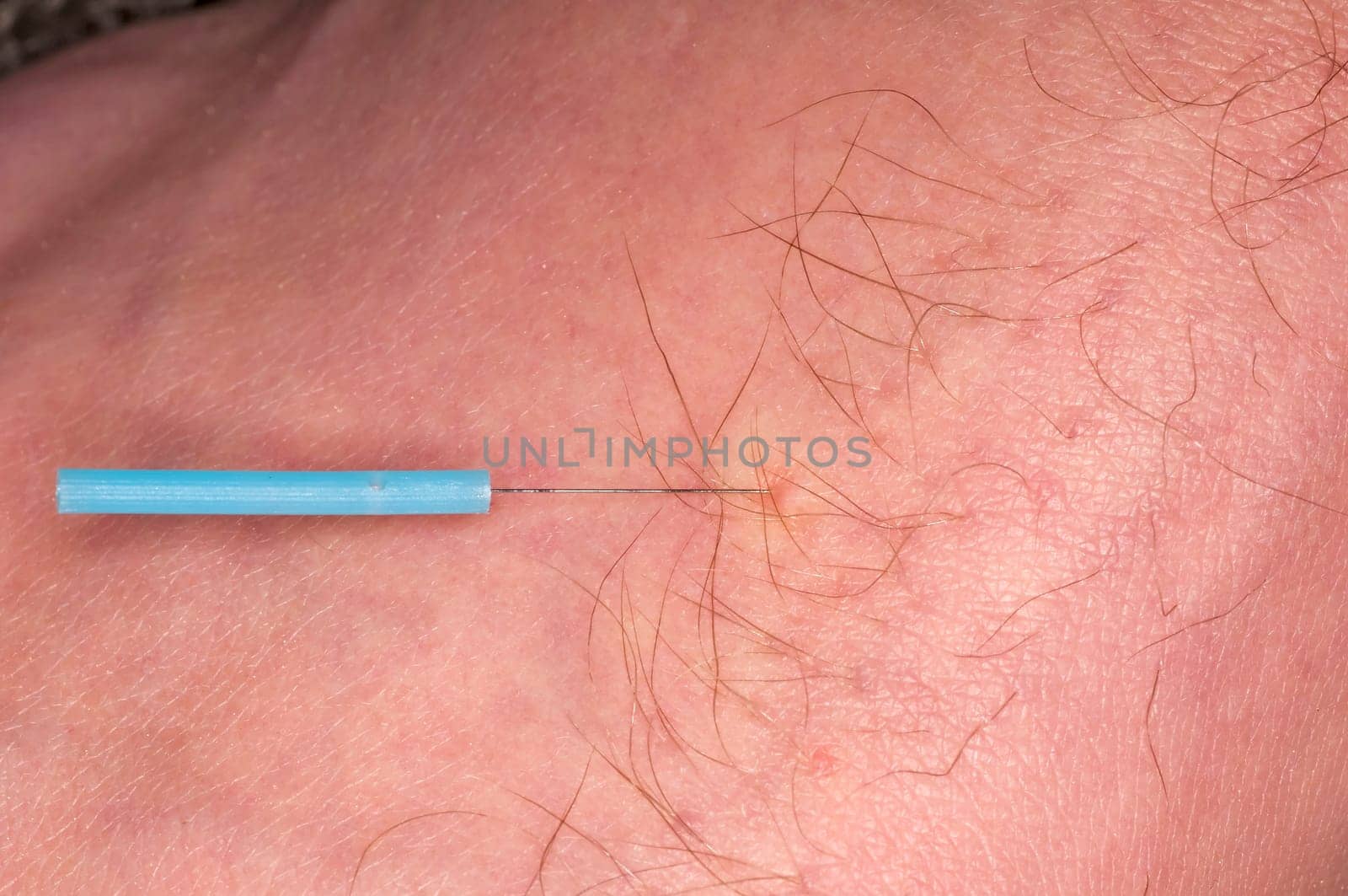 Acupuncture Therapy