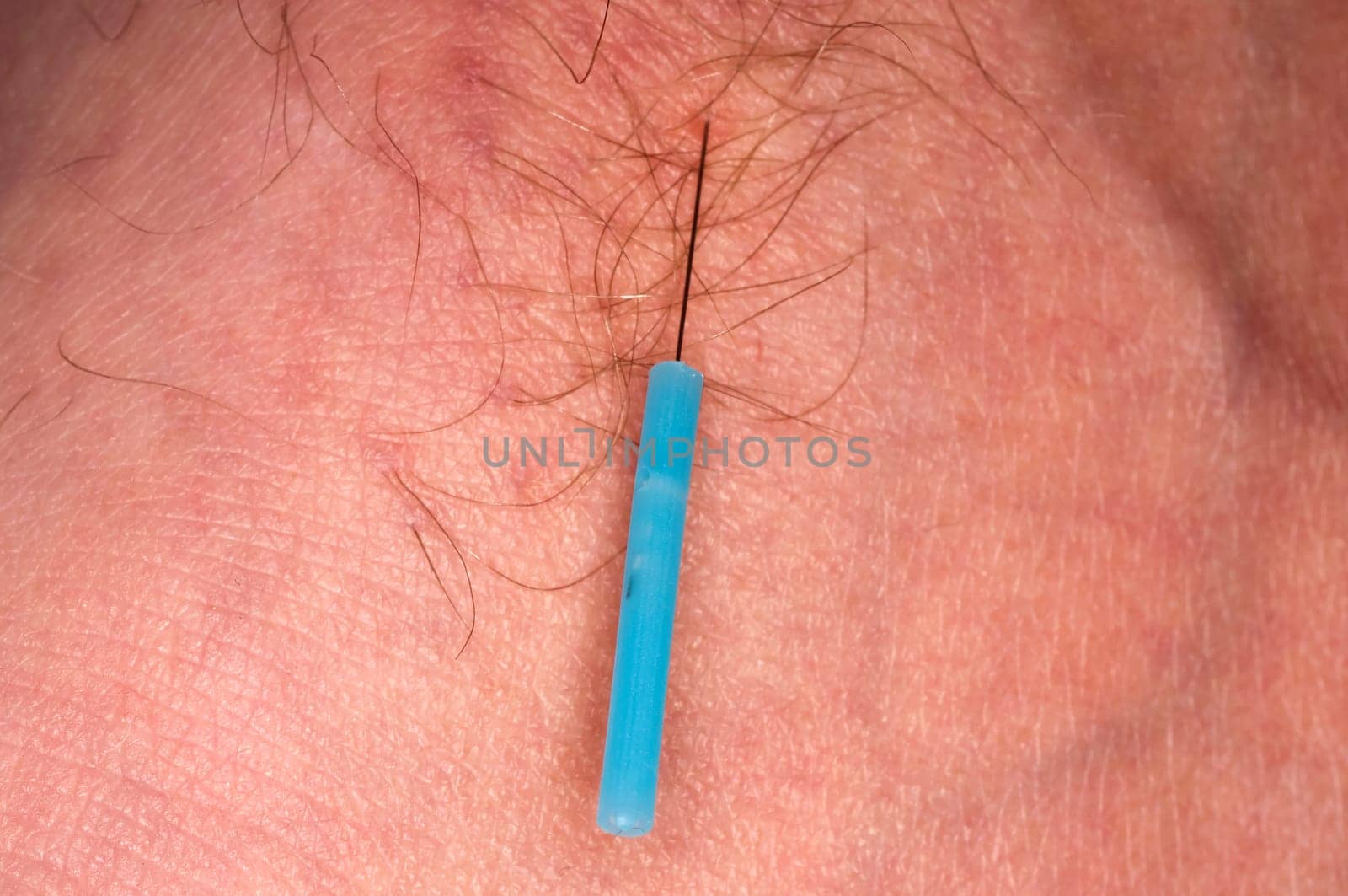 Acupuncture Therapy