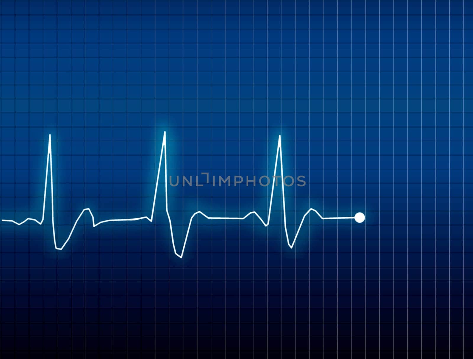 ECG Electrocardiogram