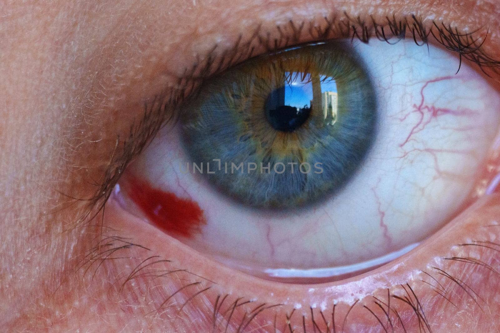 Close up of a bloodshot eye man. Hemorrhage of the eye, rupture of a vessel in the eye, blood in the eye