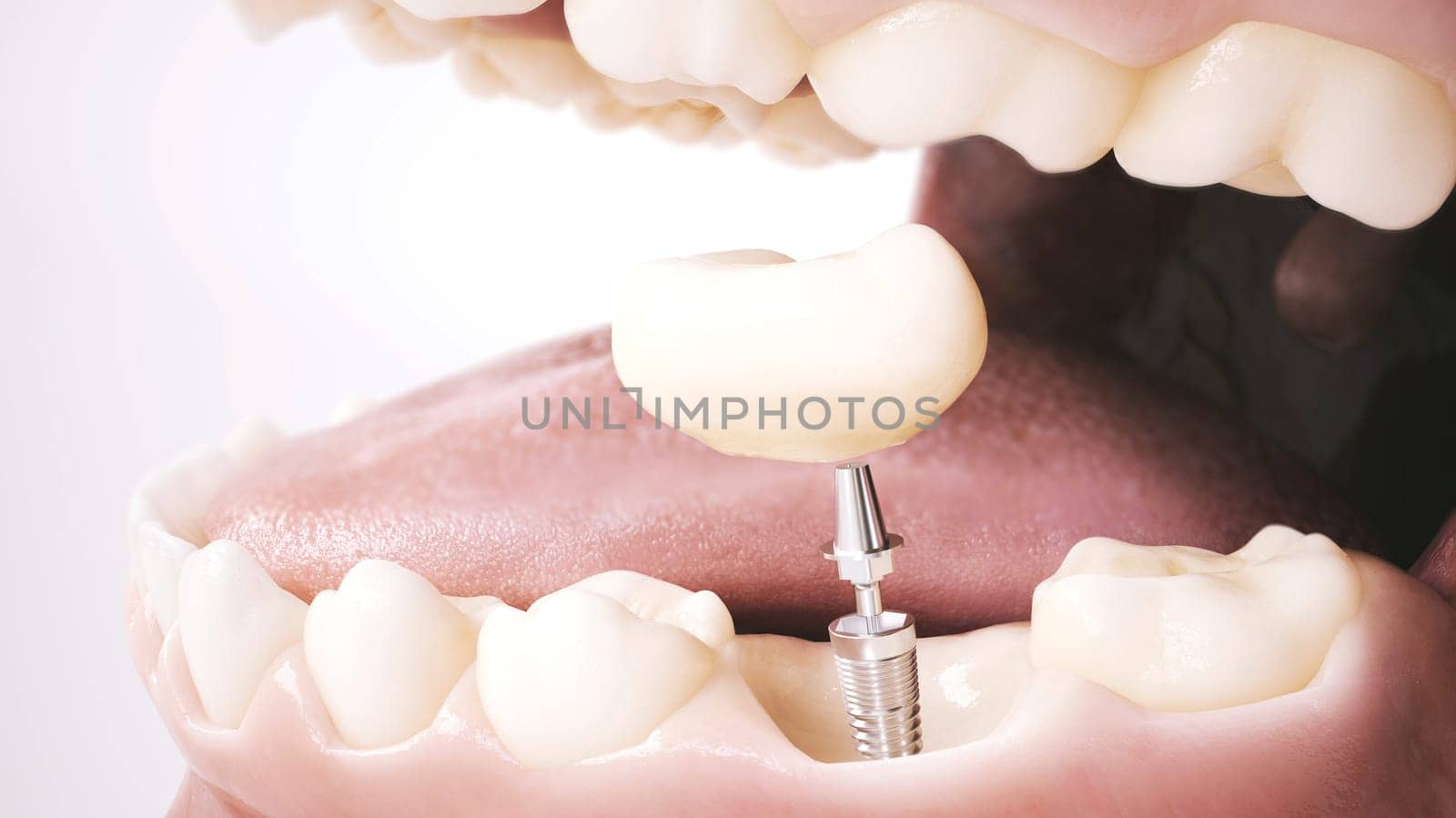 First Step to the Perfect Smile: Filling the Gap with an Implant. Part 3. 3D Rendering by Crevis