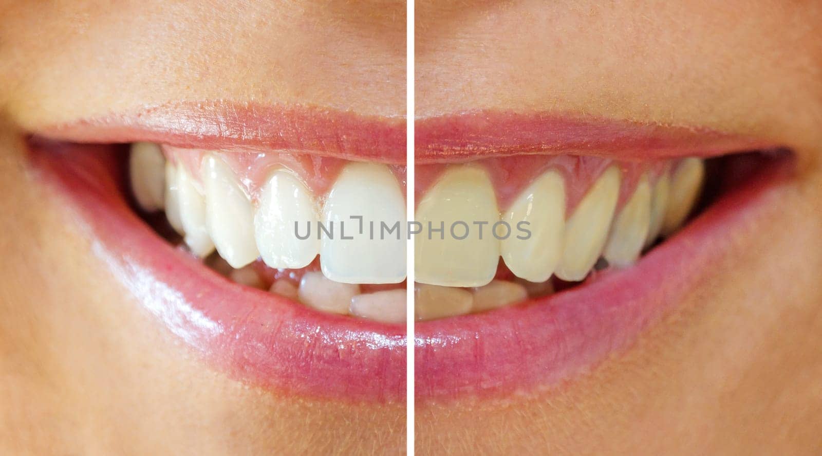 Whitening