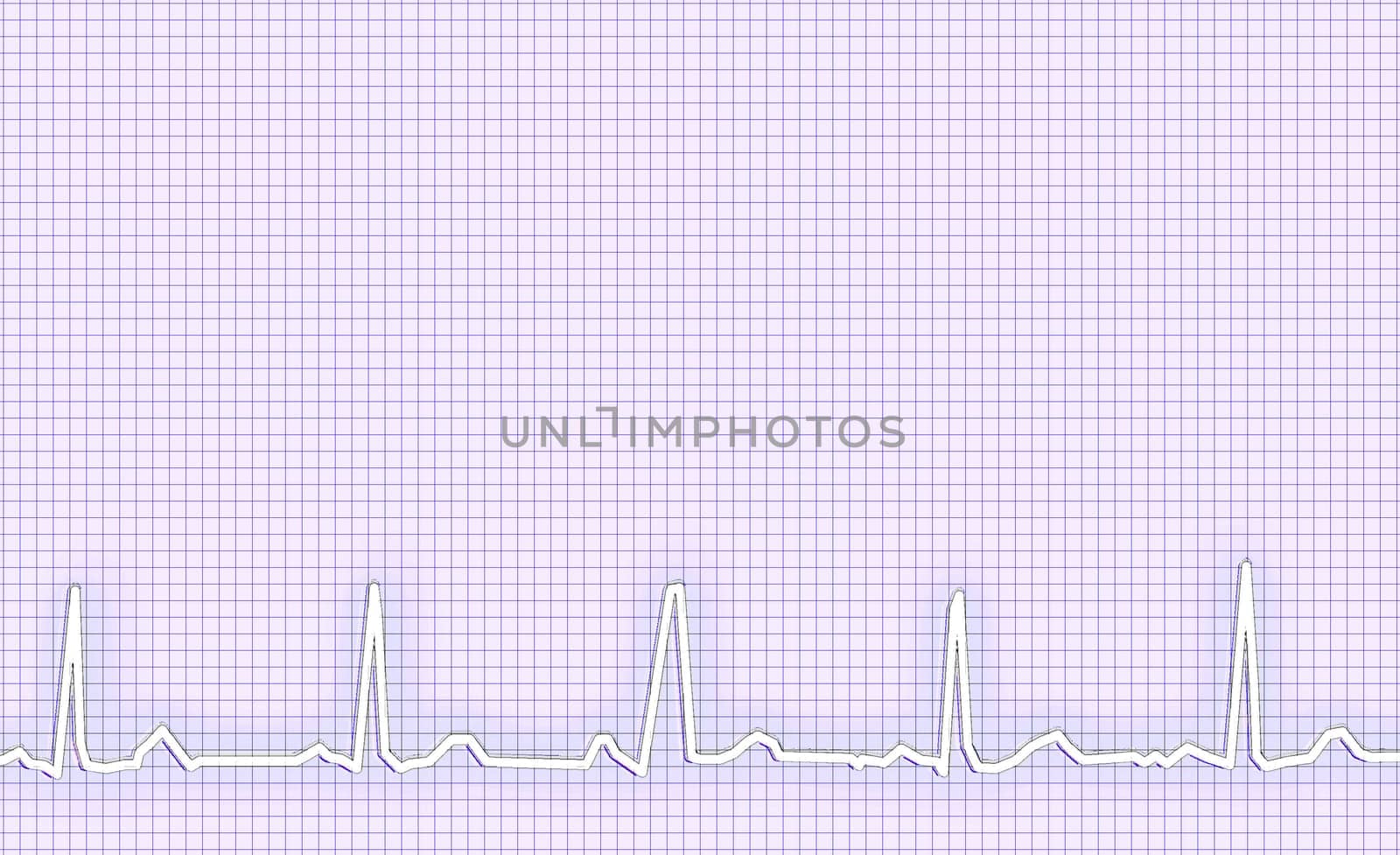 ECG Electrocardiogram