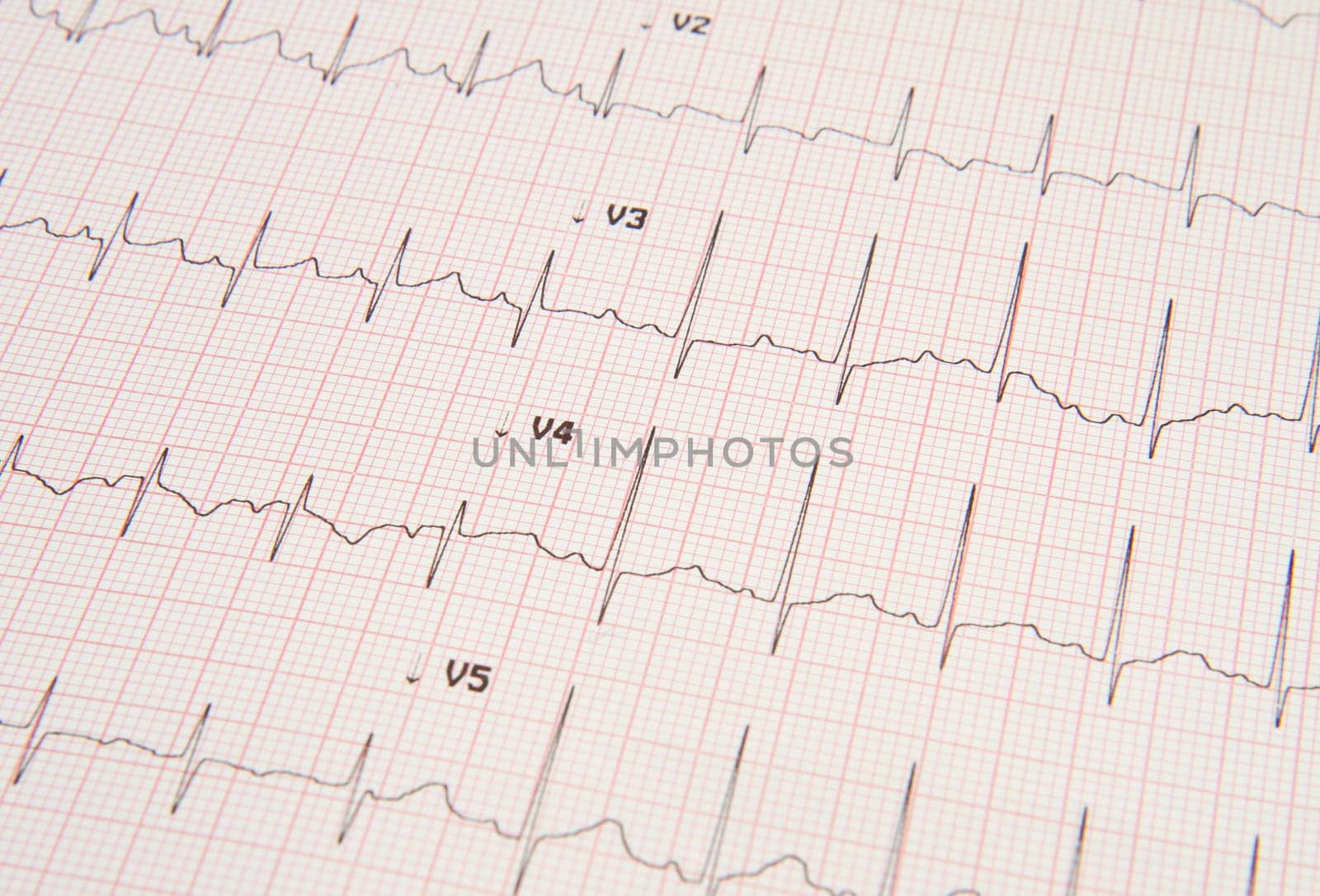 electrocardiogram