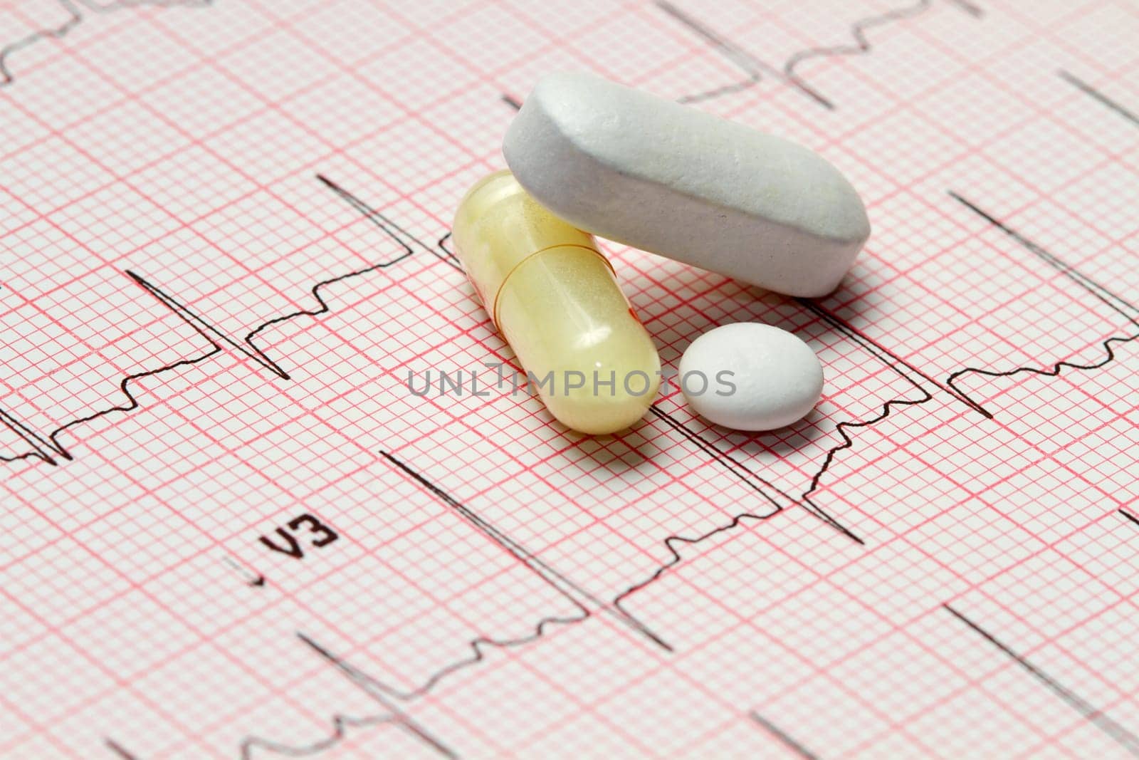 electrocardiogram