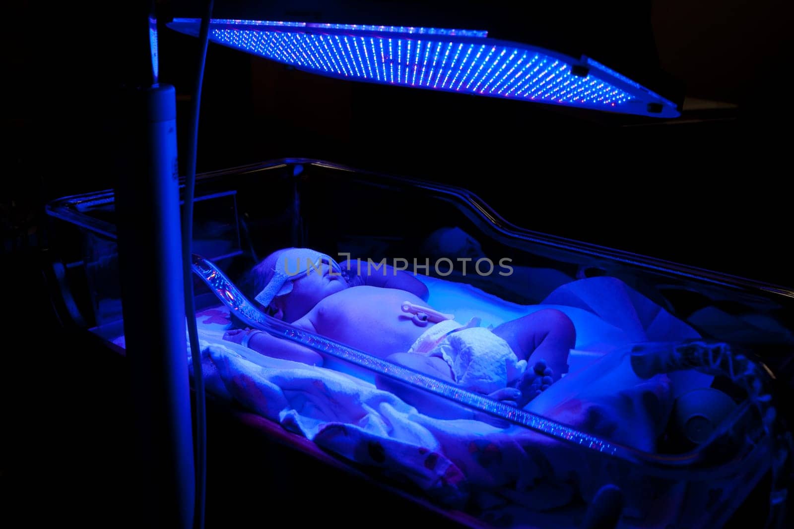 Newborn baby with neonatal jaundice and high bilirubin hyperbilirubinemia under blue UV light for phototheraphy.