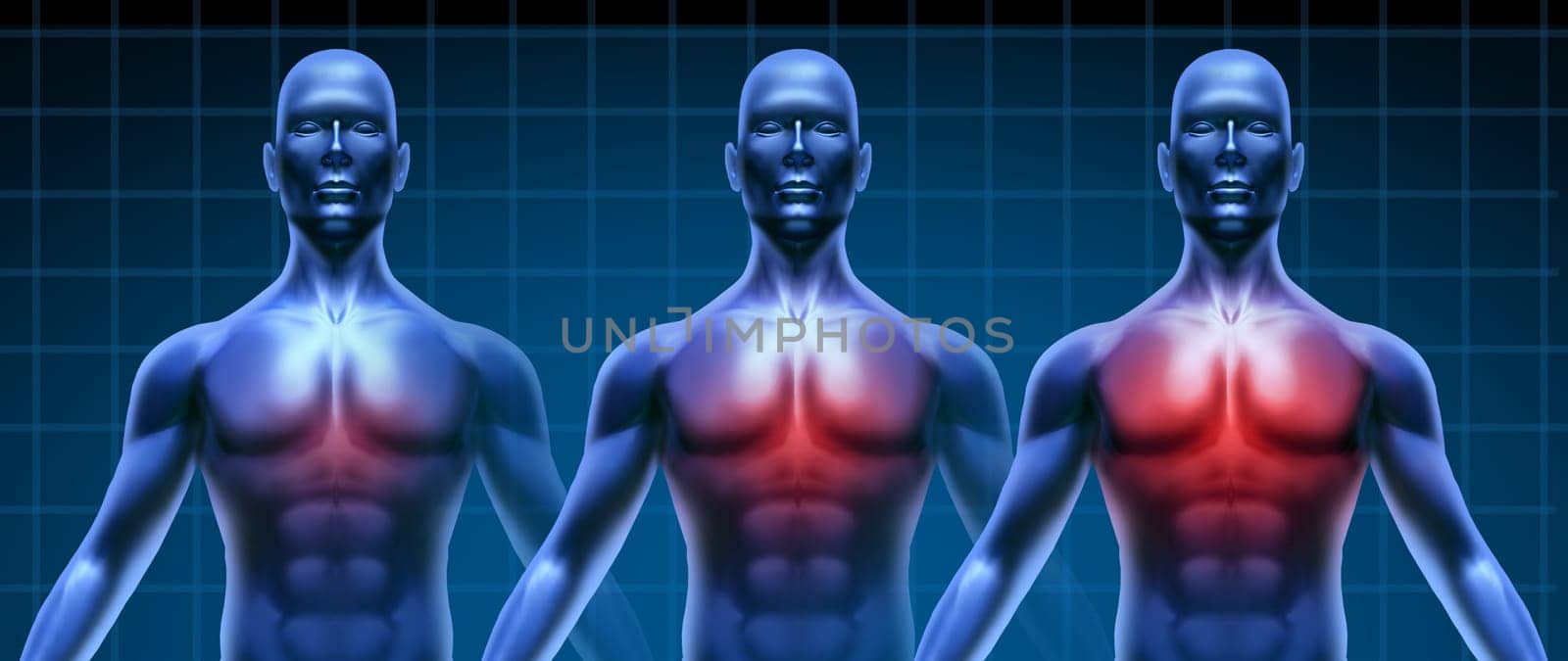 Heart illness getting gradualy worse represented by three humans with growing coronary disease of  the chest area represented by increasing red highlight of the cardiac medical inflammation.