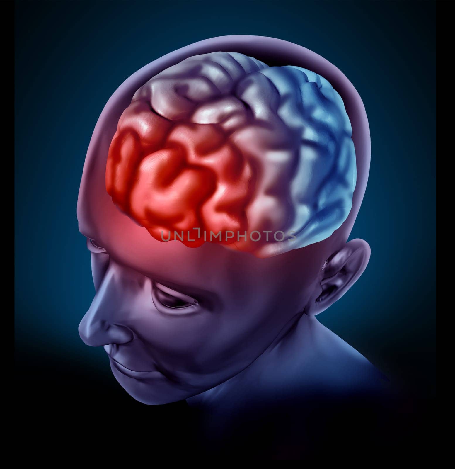 Migrain headache pain represented by a human brain with a red highlight showing the cognitive neurological disease that inflicts many patients.
