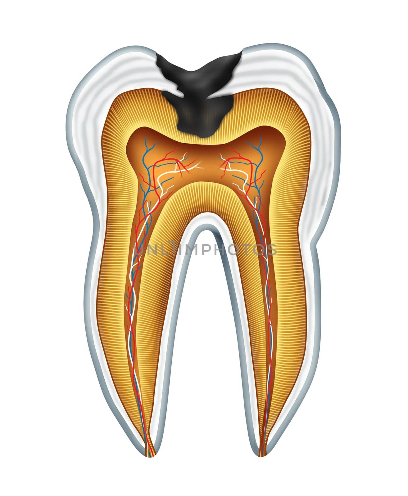 Tooth cavites symbol showing the medical cross section anatomy of teeth with a cavity in decay due to poor bacteria and acids in oral health care and lack of brushing and flosing and visiting the dentist for oral disease prevention.