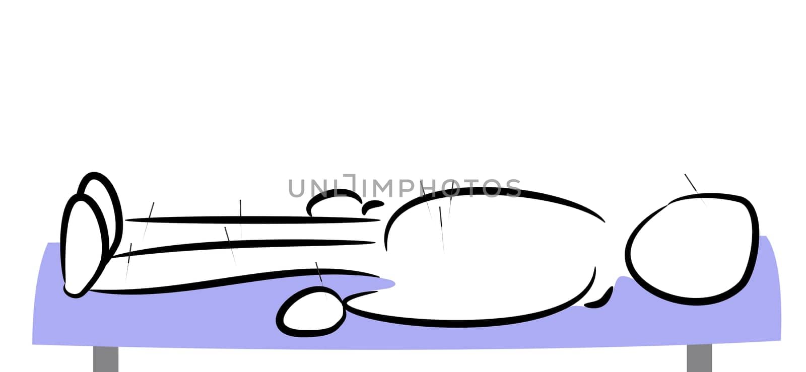 Acupuncture