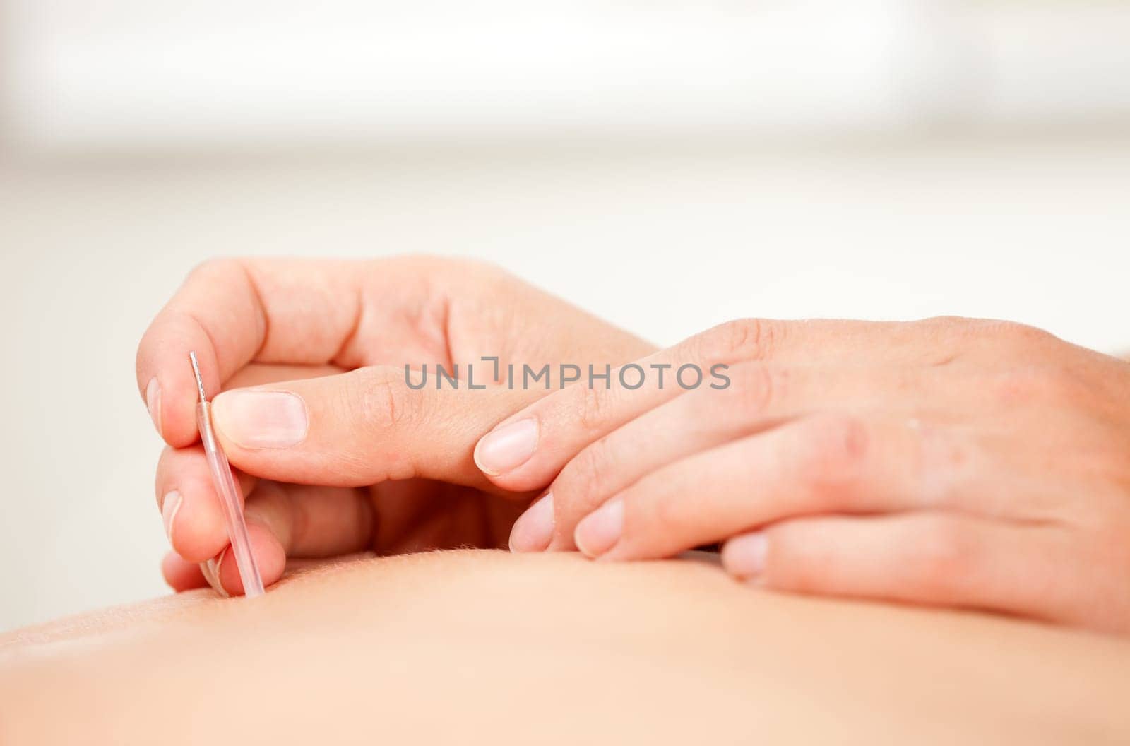 Two hands using an insertion tube with a Goshin acupuncture needle to insert a needle in the back of a patient