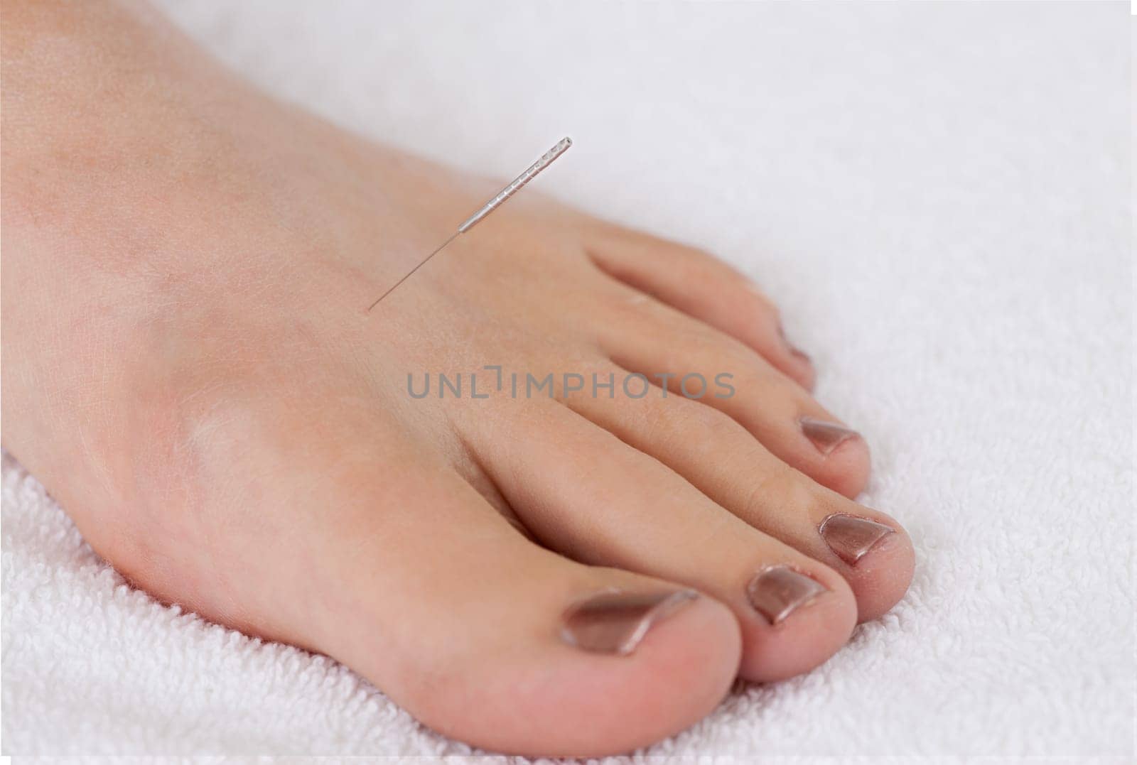 Detail of acupuncture needle in the Liver 3 (liv3) point