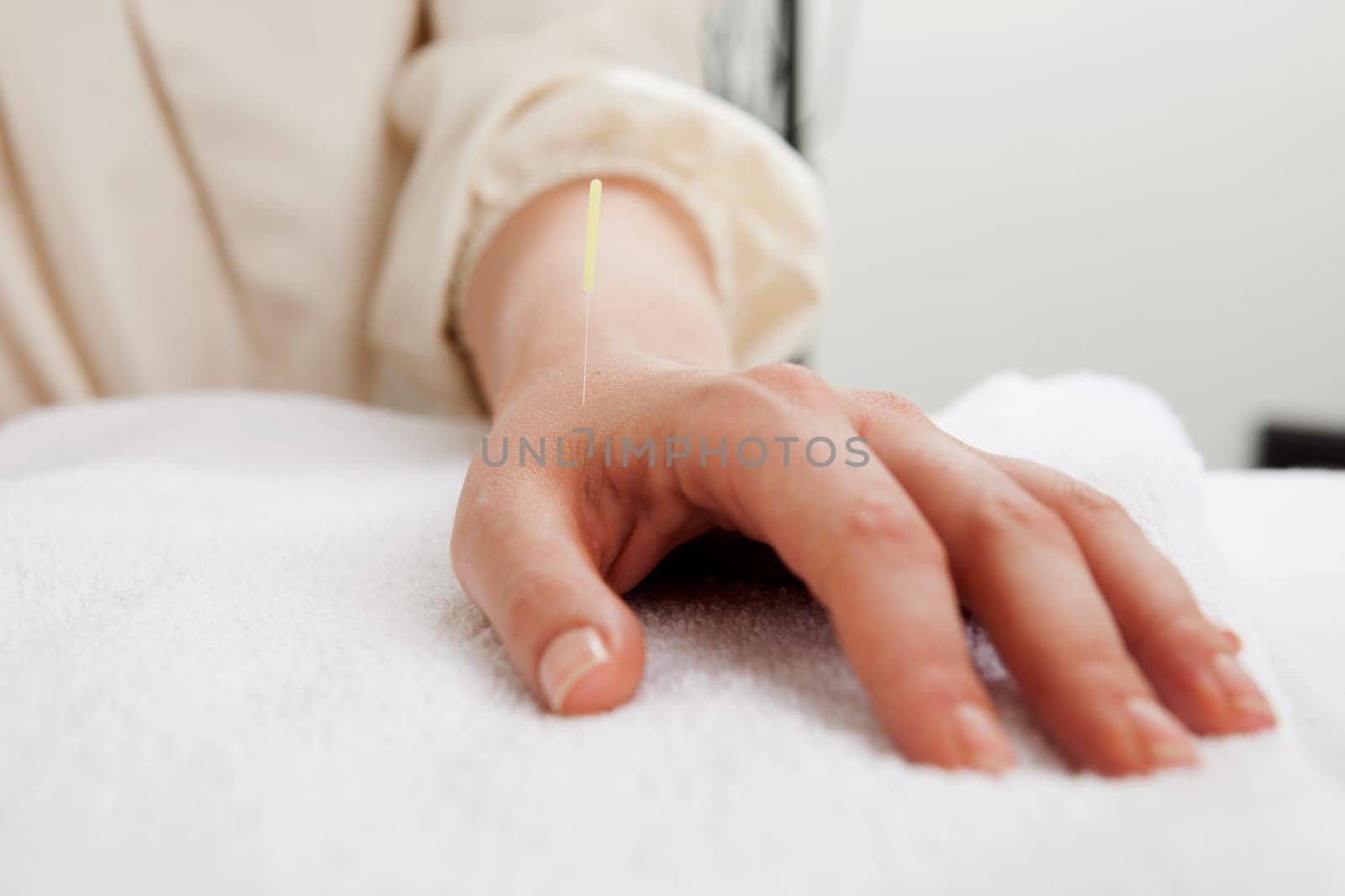 Acupuncture needle in LI4 (large intestine 4) point