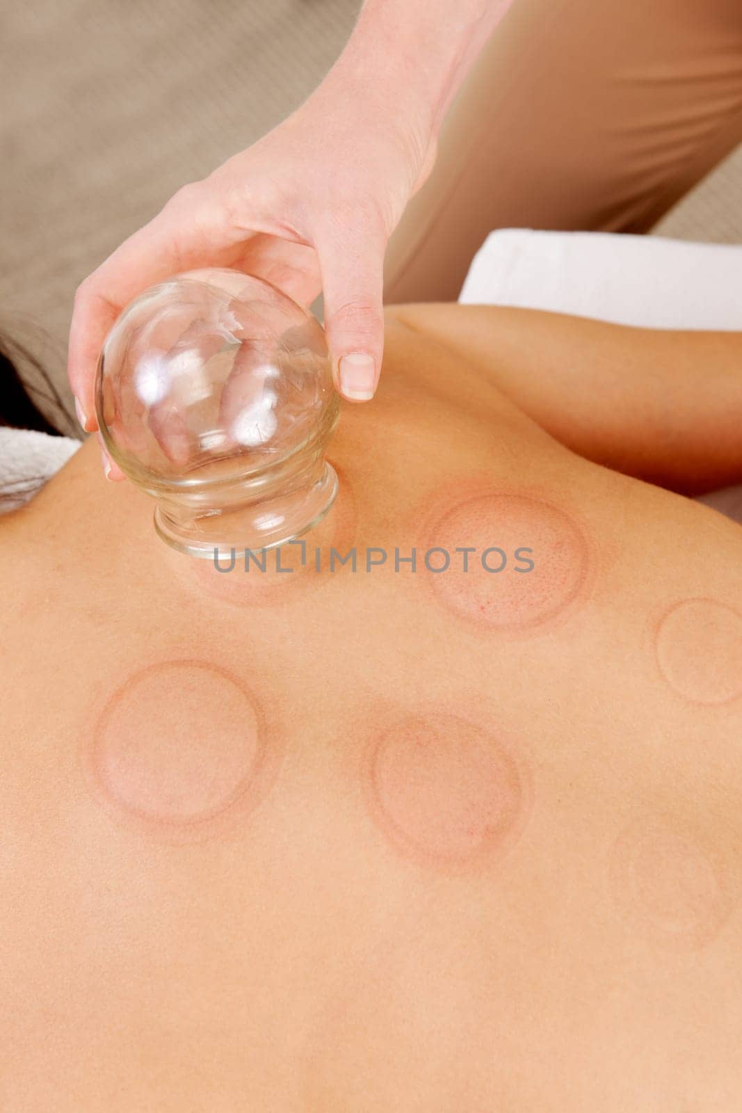 Back detail of a young woman who just underwent an acupuncture fire cupping treatment