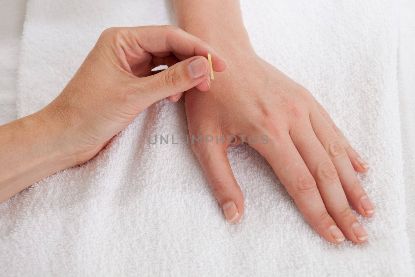 Detail of acupuncturist placing a needle in the Large Intestine 4 (LI4) point