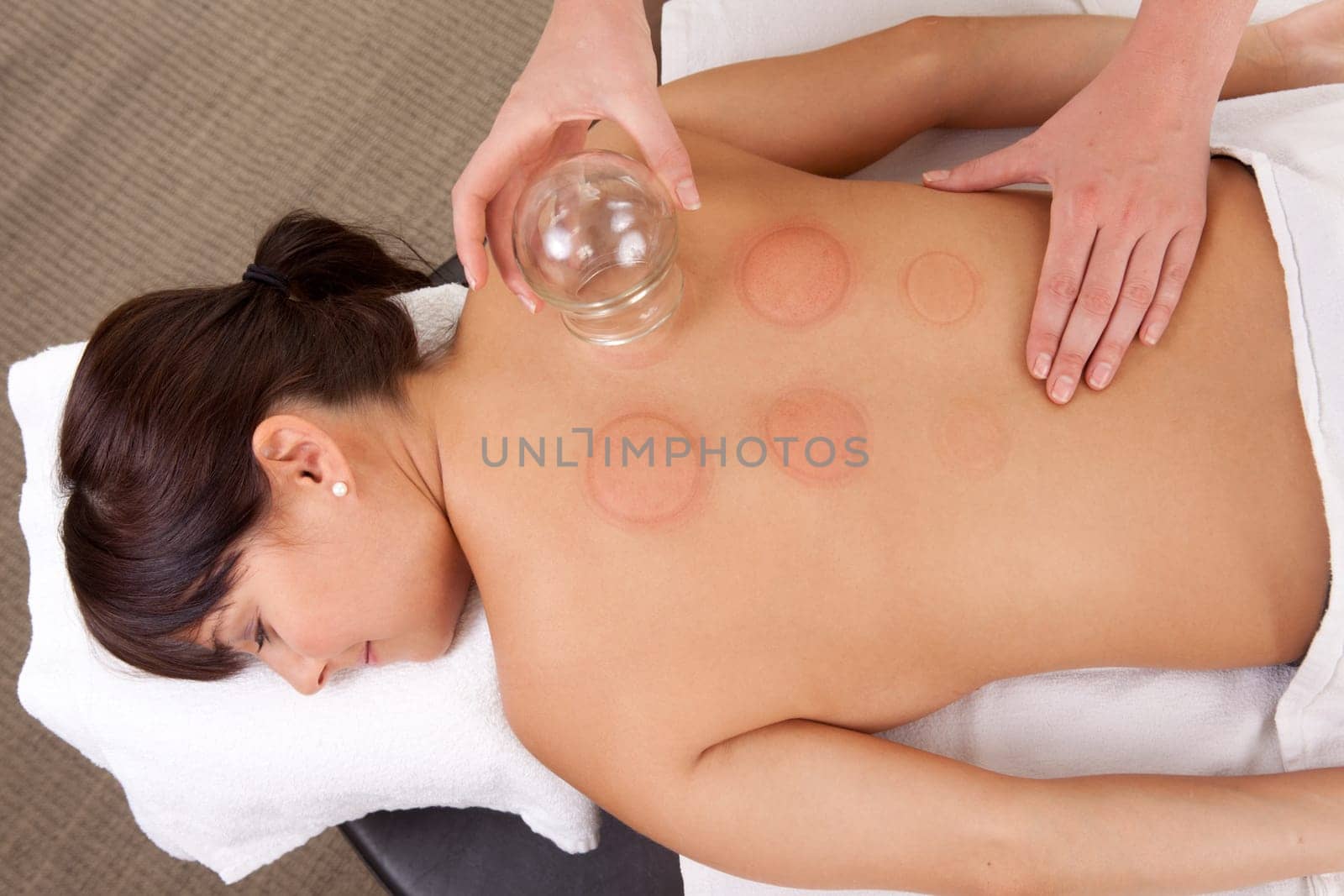 Back detail of a young woman who just underwent an acupuncture fire cupping treatment