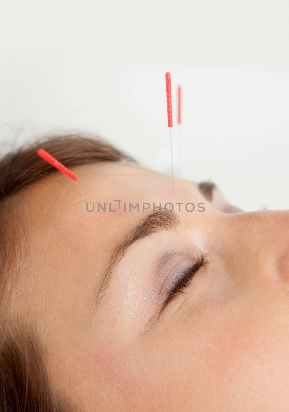 Macro detail of three needles in face of patient