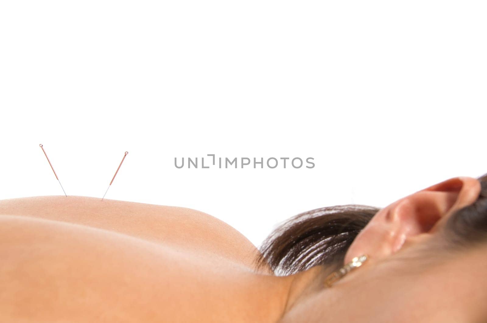 Woman getting an acupuncture treatment in a spa