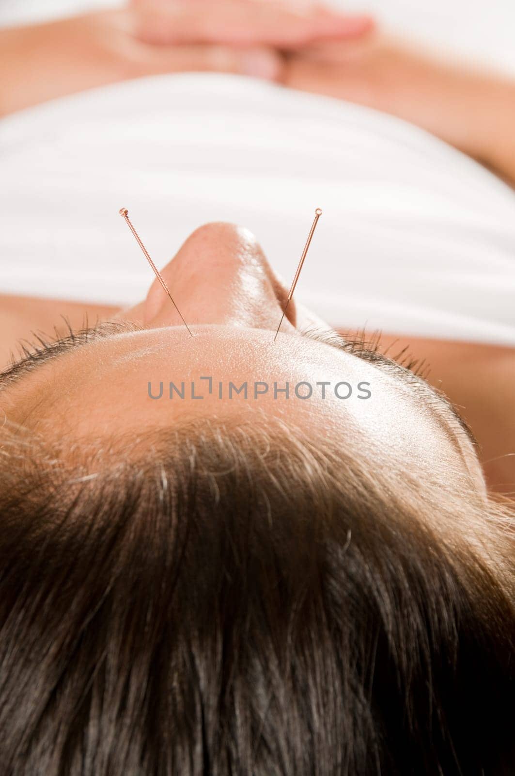 Woman getting an acupuncture treatment in a spa