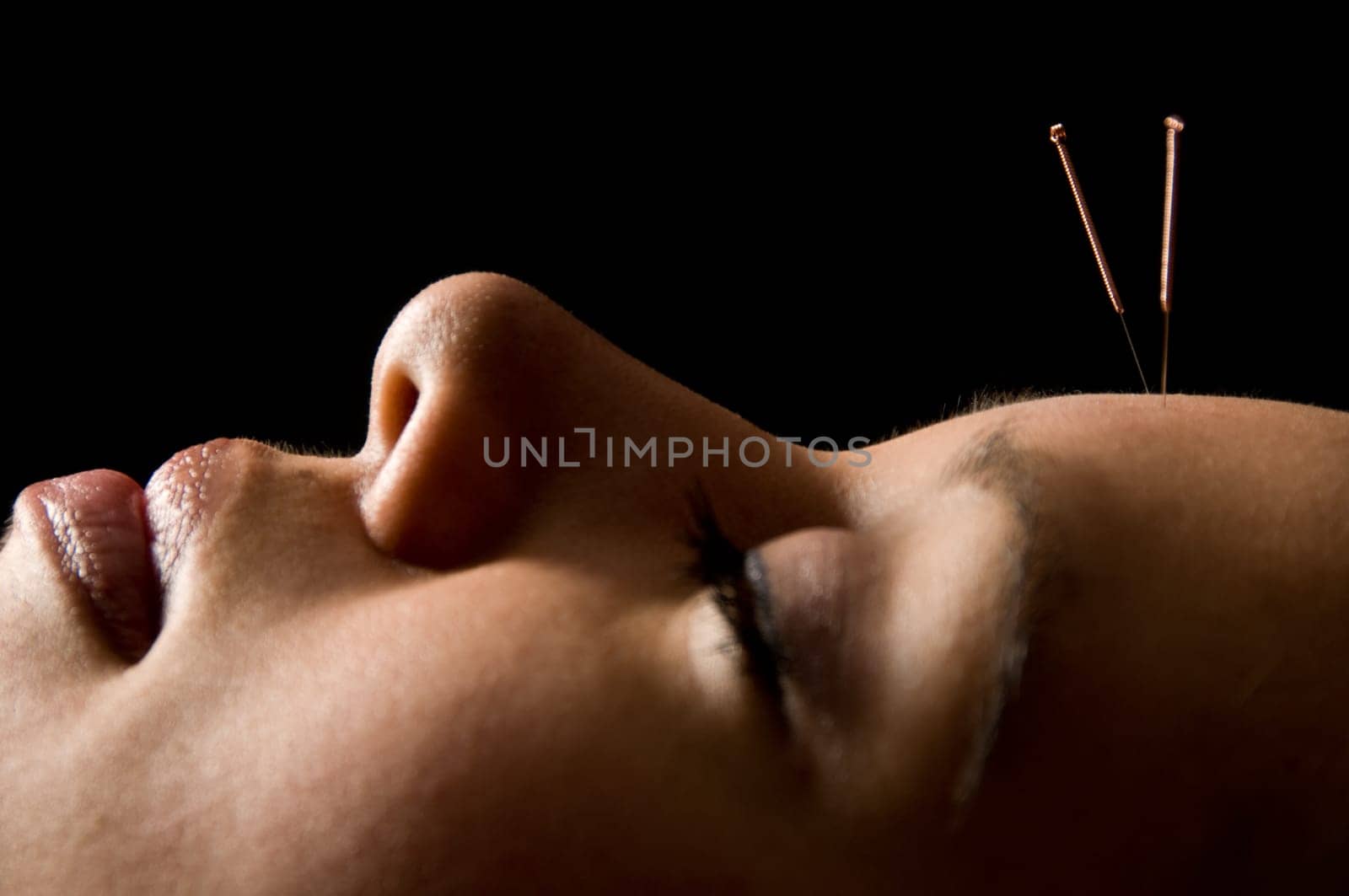 Woman getting an acupuncture treatment in a spa