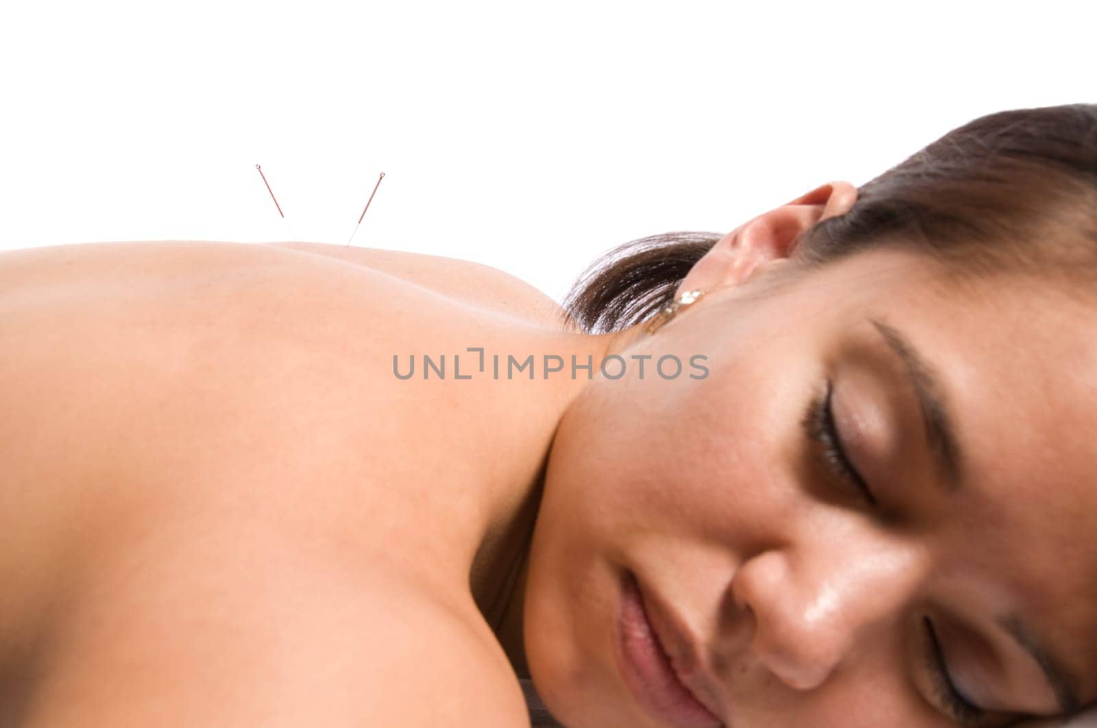 Woman getting an acupuncture treatment in a spa