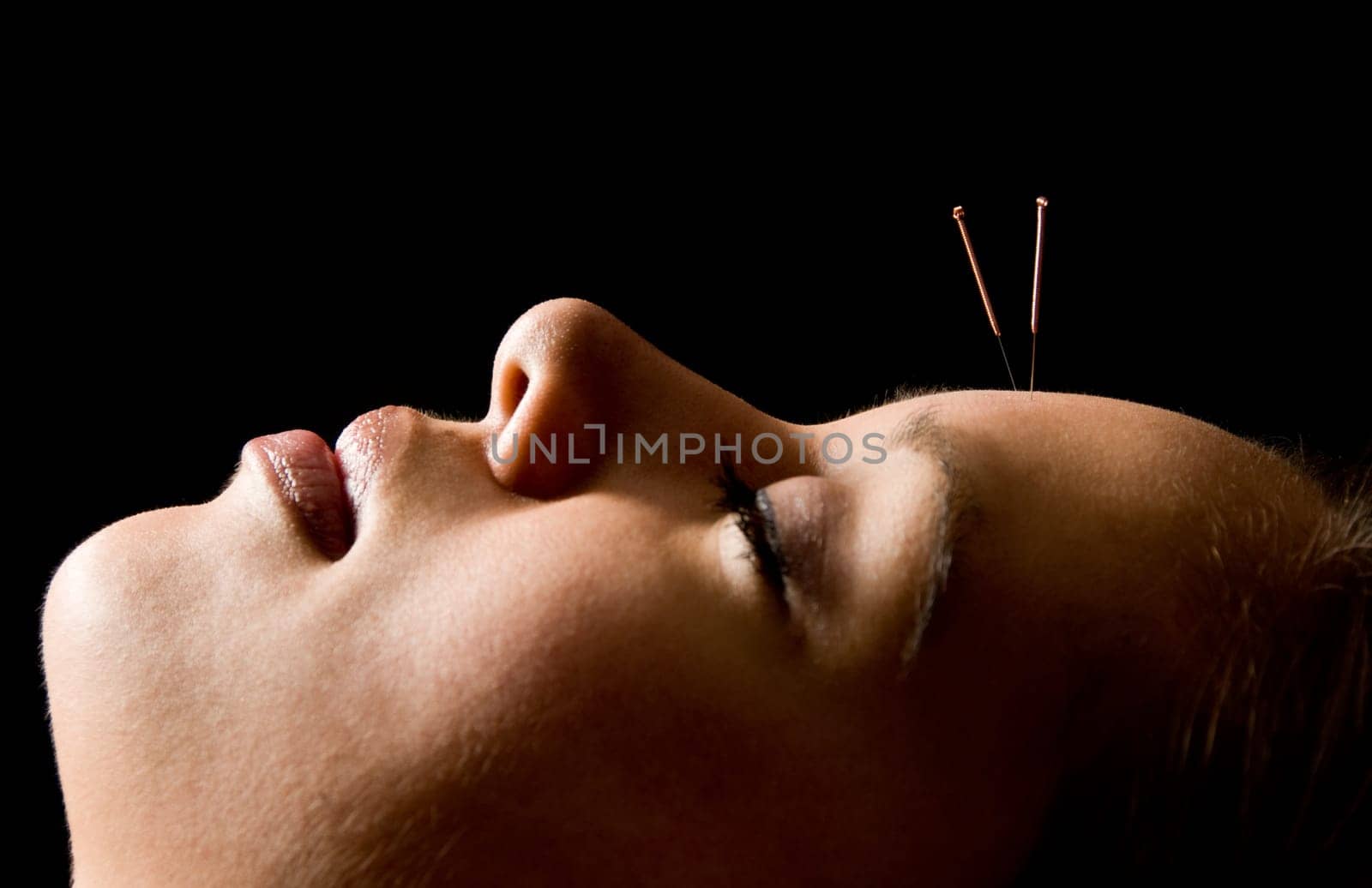 Woman getting an acupuncture treatment in a spa