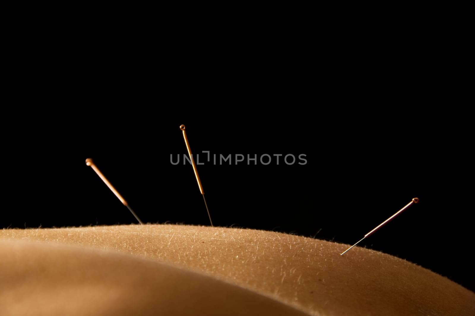 Woman getting an acupuncture treatment in a spa