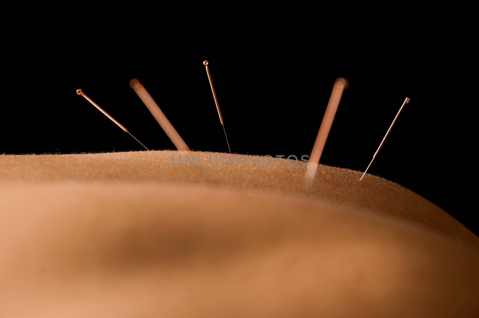 Woman getting an acupuncture treatment in a spa